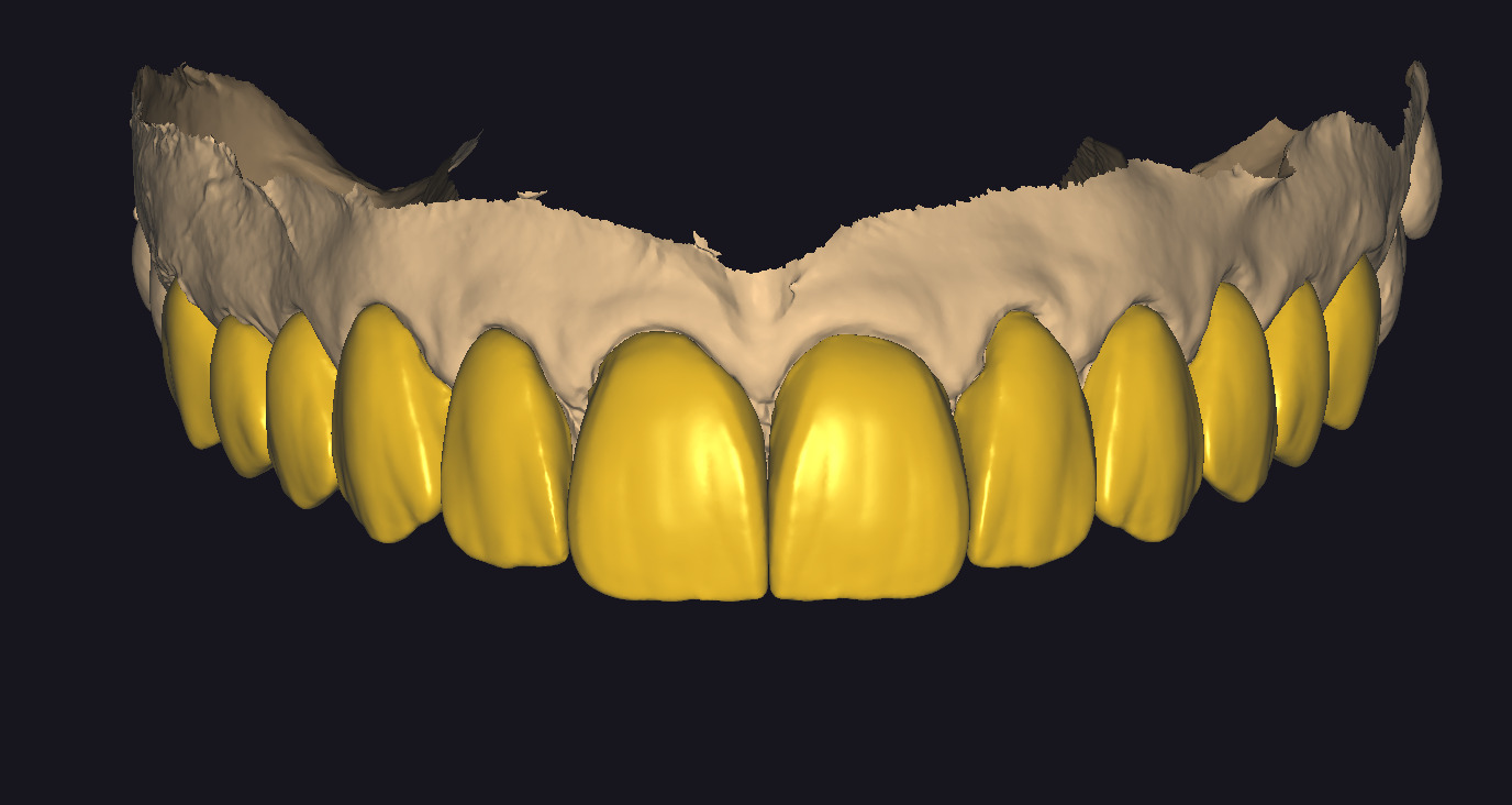 The complete set of - 34 Grin Design dental libraries - Exocad Low-poly 3D model_2