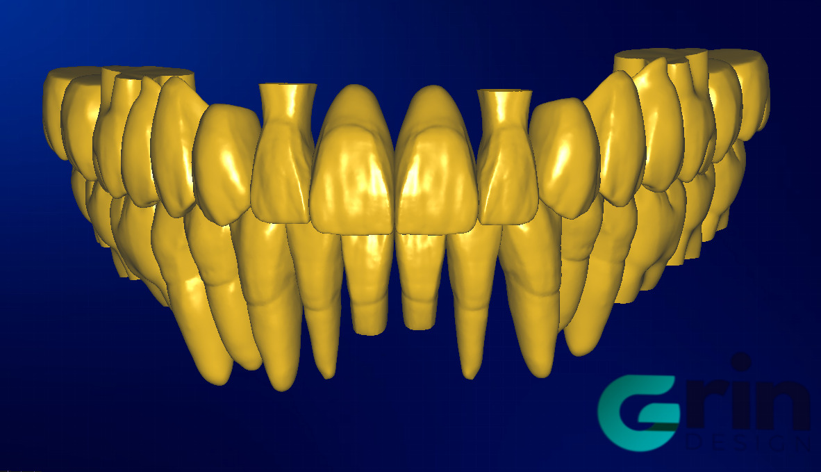 The complete set of - 34 Grin Design dental libraries - Exocad Low-poly 3D model_9
