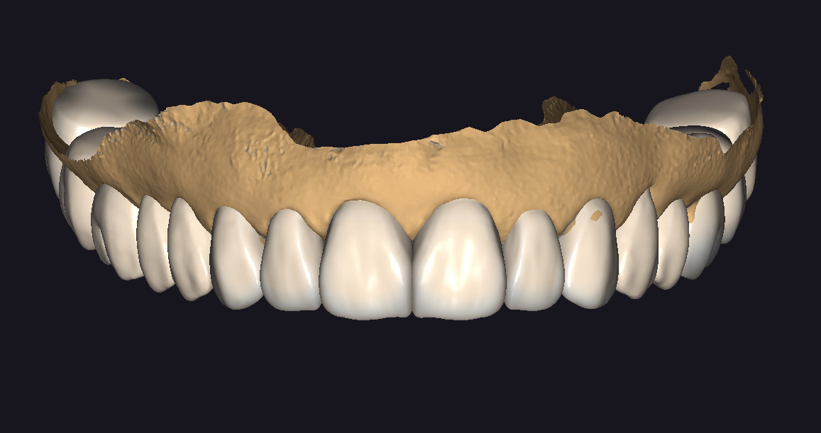 The complete set of - 34 Grin Design dental libraries - Exocad Low-poly 3D model_18