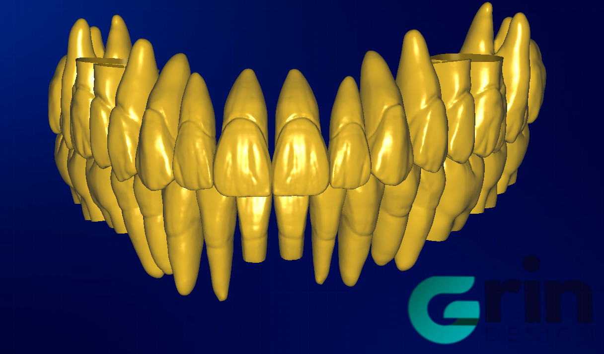 The complete set of - 34 Grin Design dental libraries - Exocad Low-poly 3D model_7