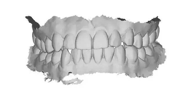 P020 - Dental - Intraoral Scan STL-PLY-OBJ 3D print model