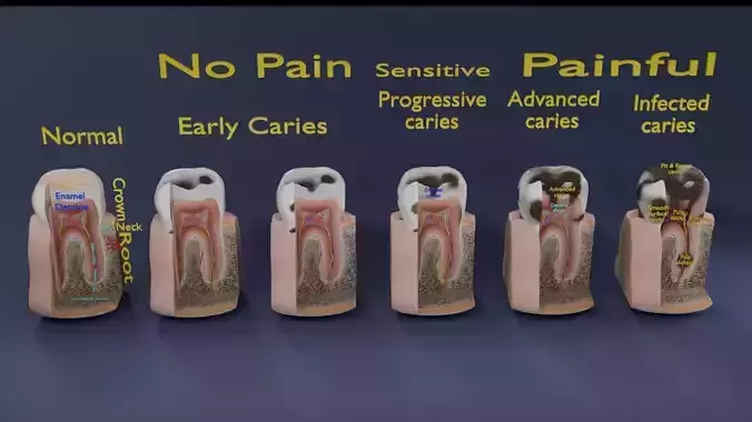 Caries Teeth severity schematic cut sectional  Low-poly 3D model
