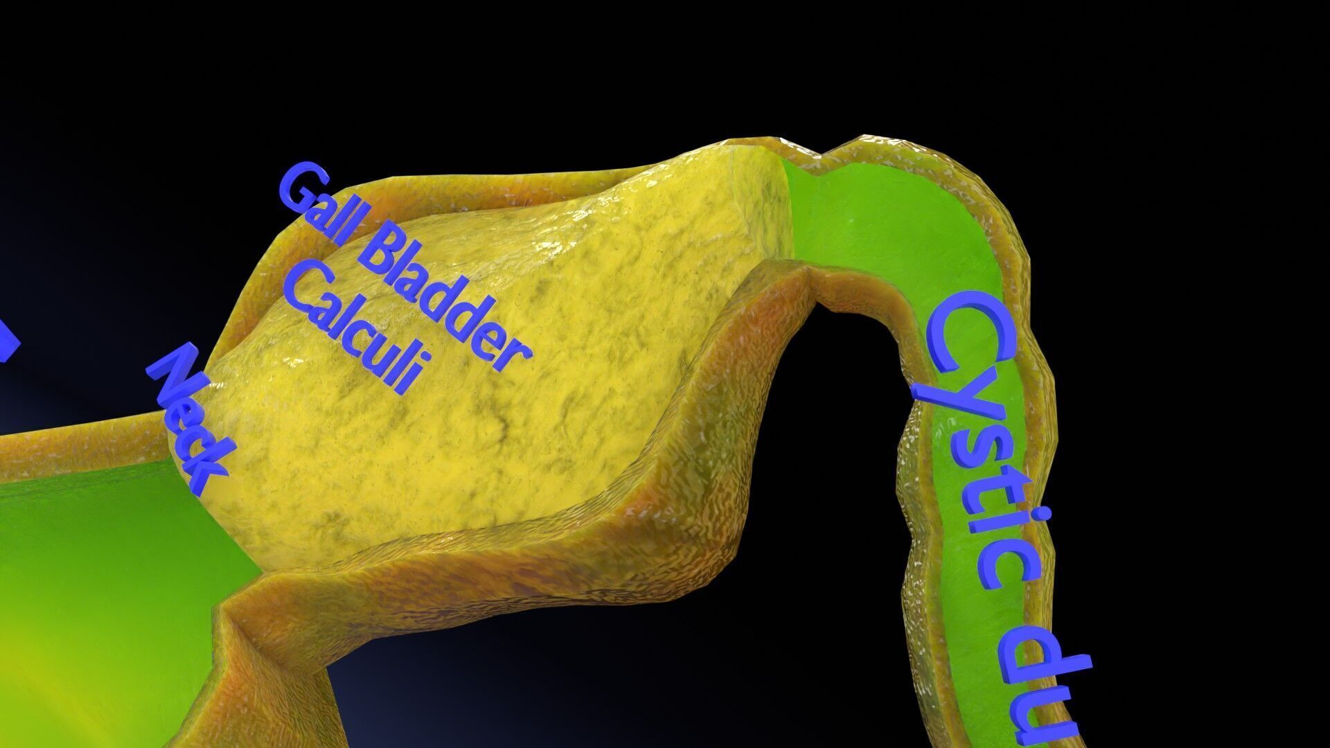 Biliary tract stone obstructions gallstone Low-poly 3D model_11