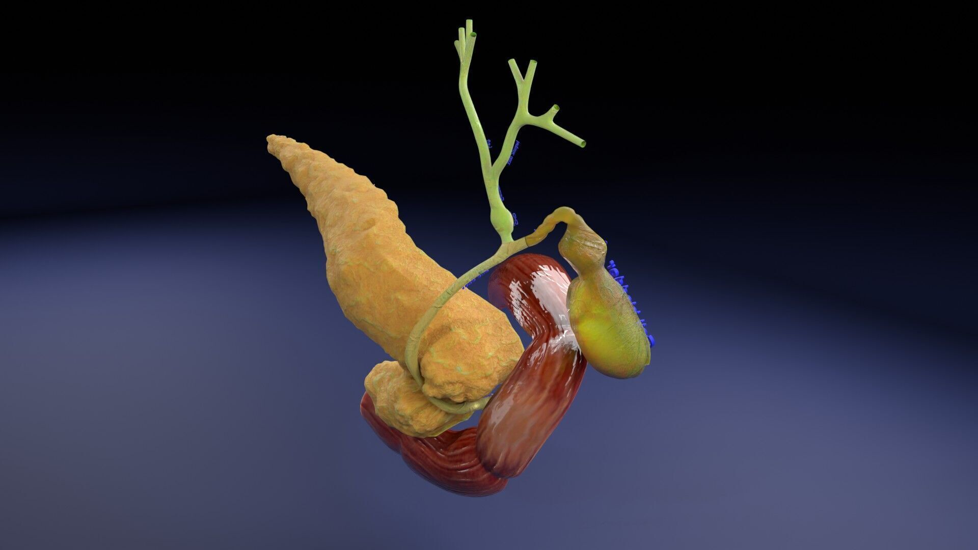 Biliary tract stone obstructions gallstone Low-poly 3D model_37