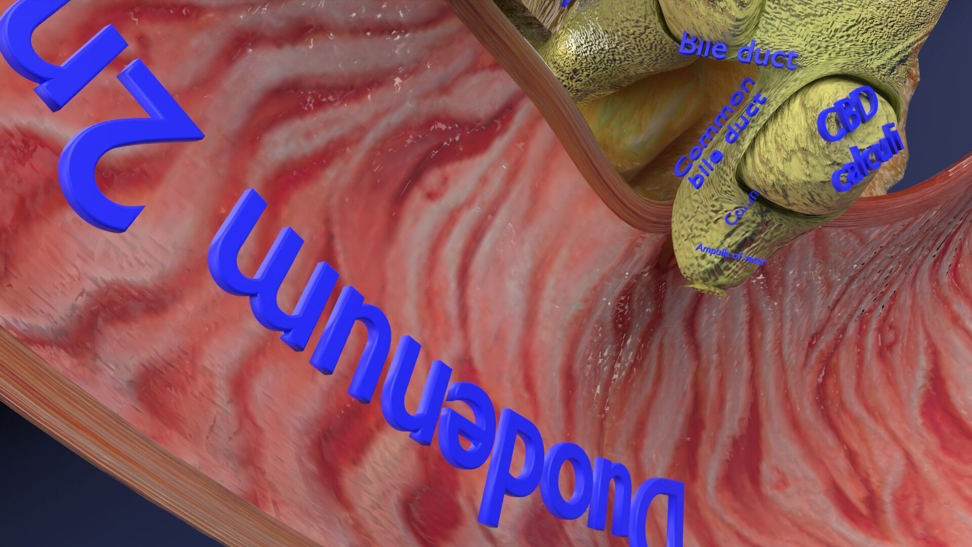 Biliary tract stone obstructions gallstone Low-poly 3D model_18