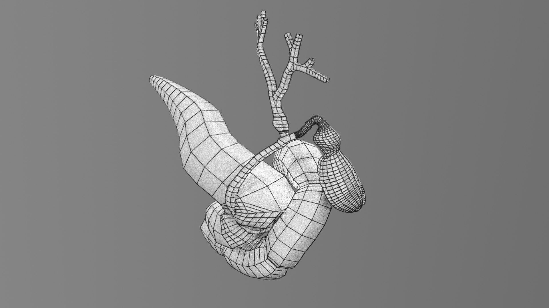 Biliary tract stone obstructions gallstone Low-poly 3D model_77
