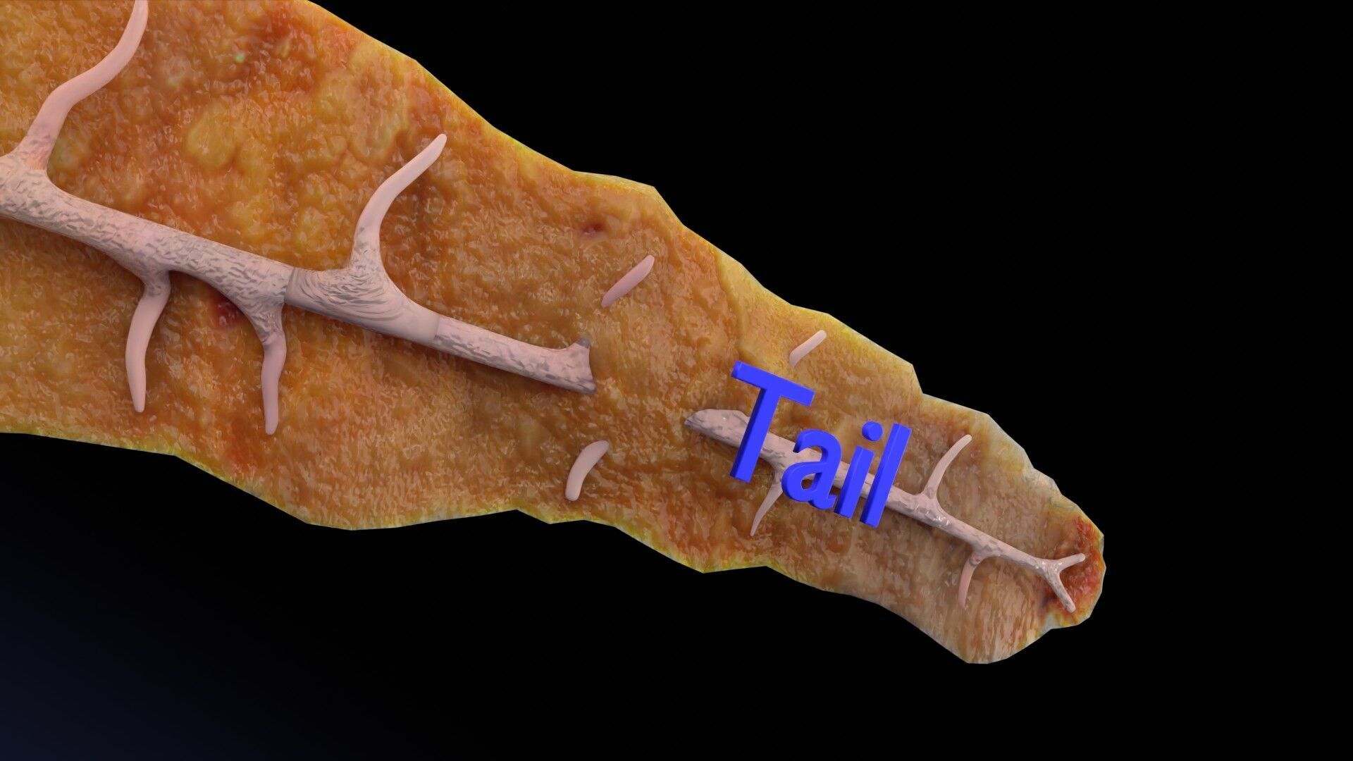 Biliary tract stone obstructions gallstone Low-poly 3D model_28