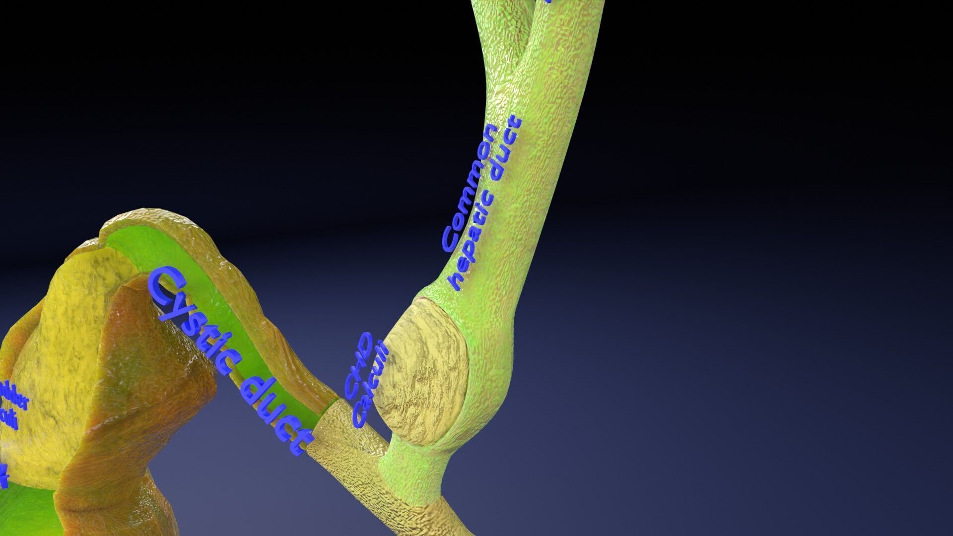 Biliary tract stone obstructions gallstone Low-poly 3D model_6