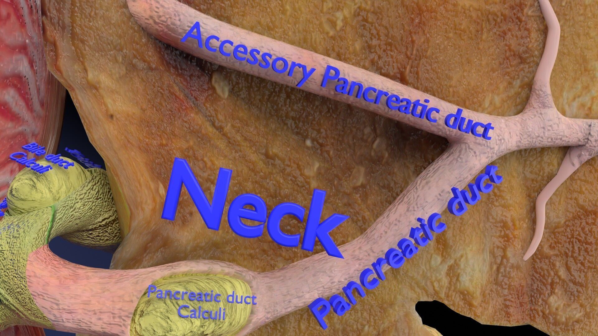 Biliary tract stone obstructions gallstone Low-poly 3D model_24