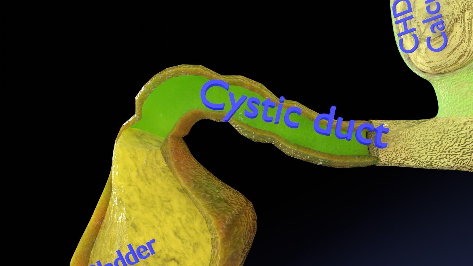 Biliary tract stone obstructions gallstone Low-poly 3D model_12