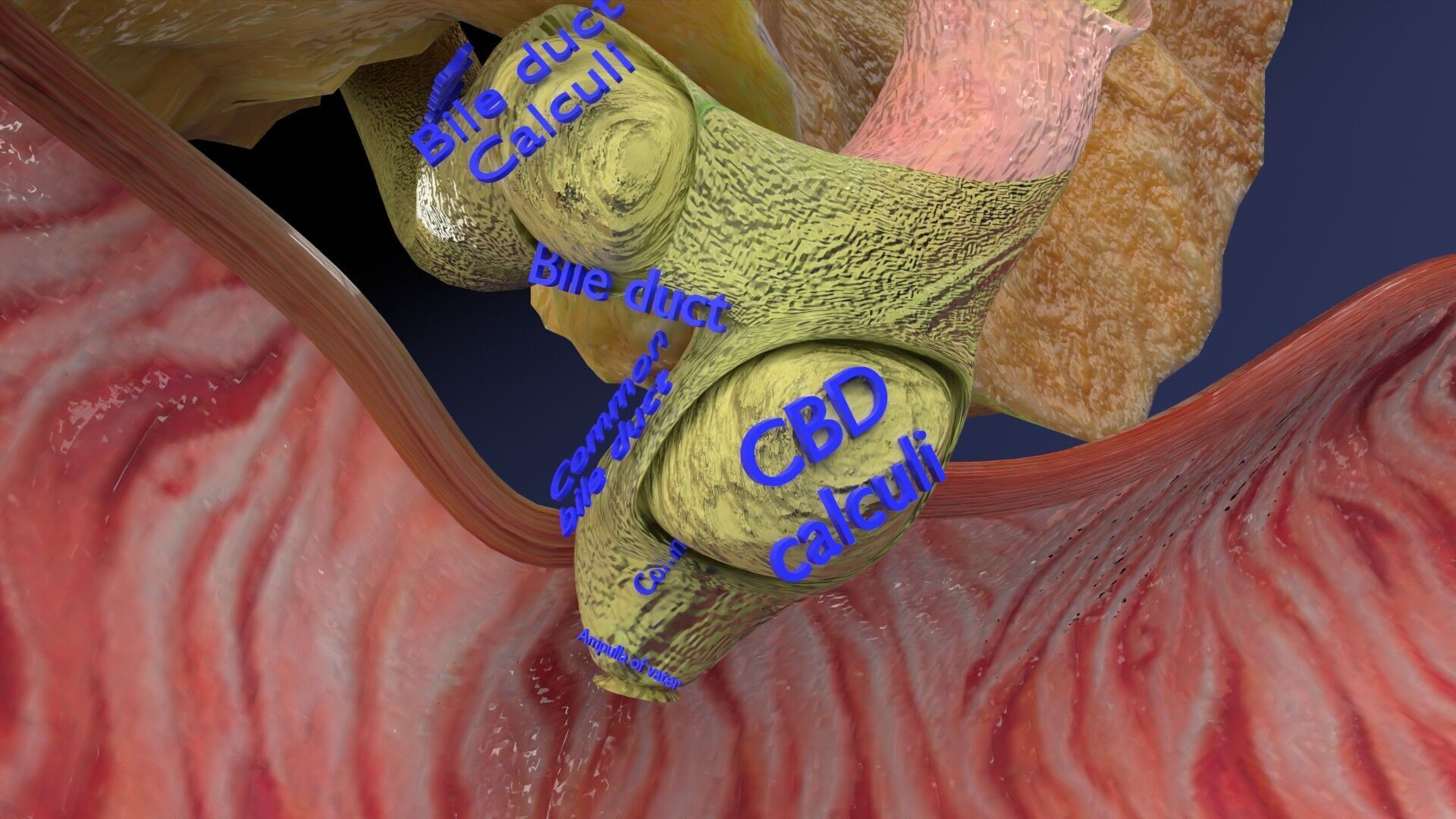 Biliary tract stone obstructions gallstone Low-poly 3D model_19