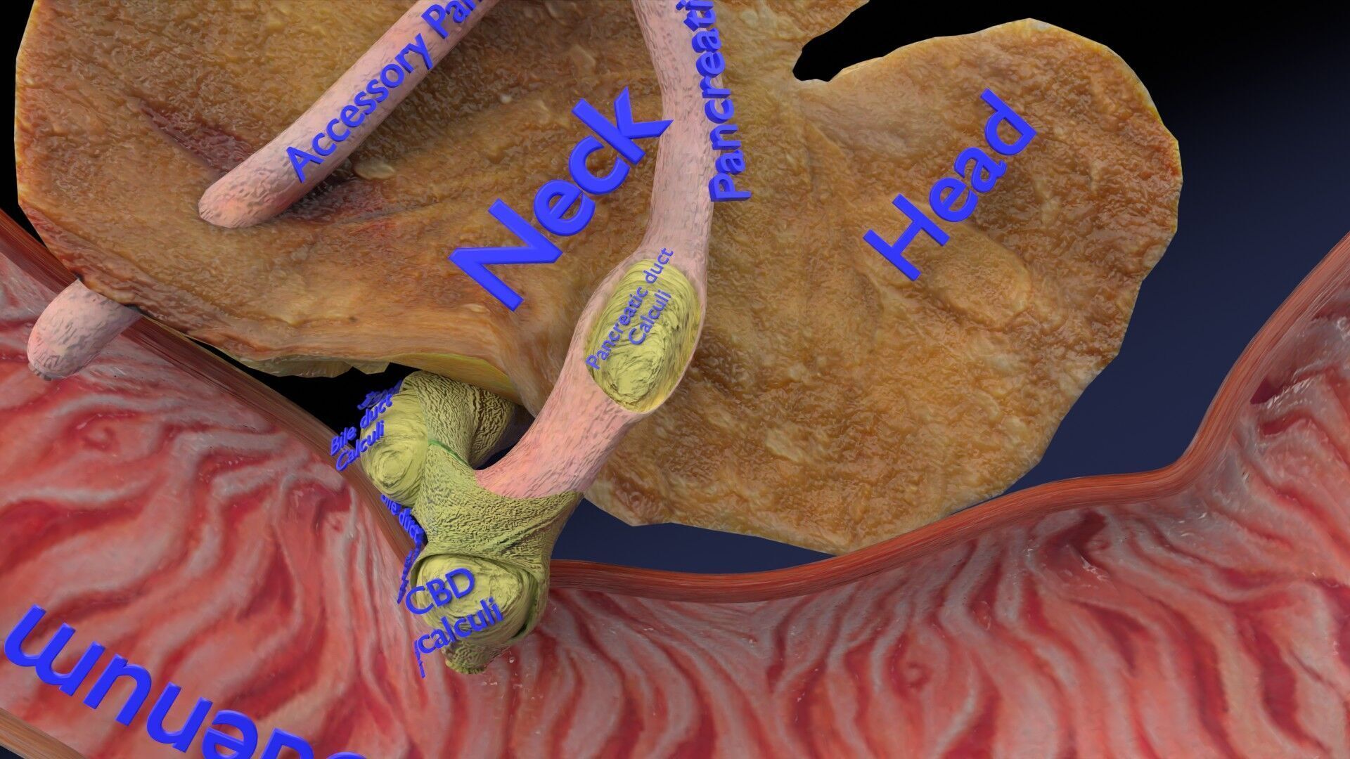 Biliary tract stone obstructions gallstone Low-poly 3D model_20