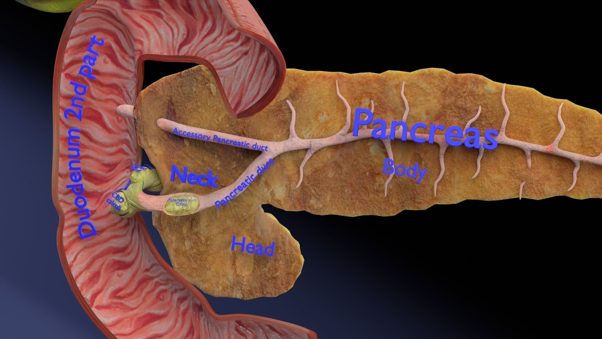 Biliary tract stone obstructions gallstone Low-poly 3D model_32