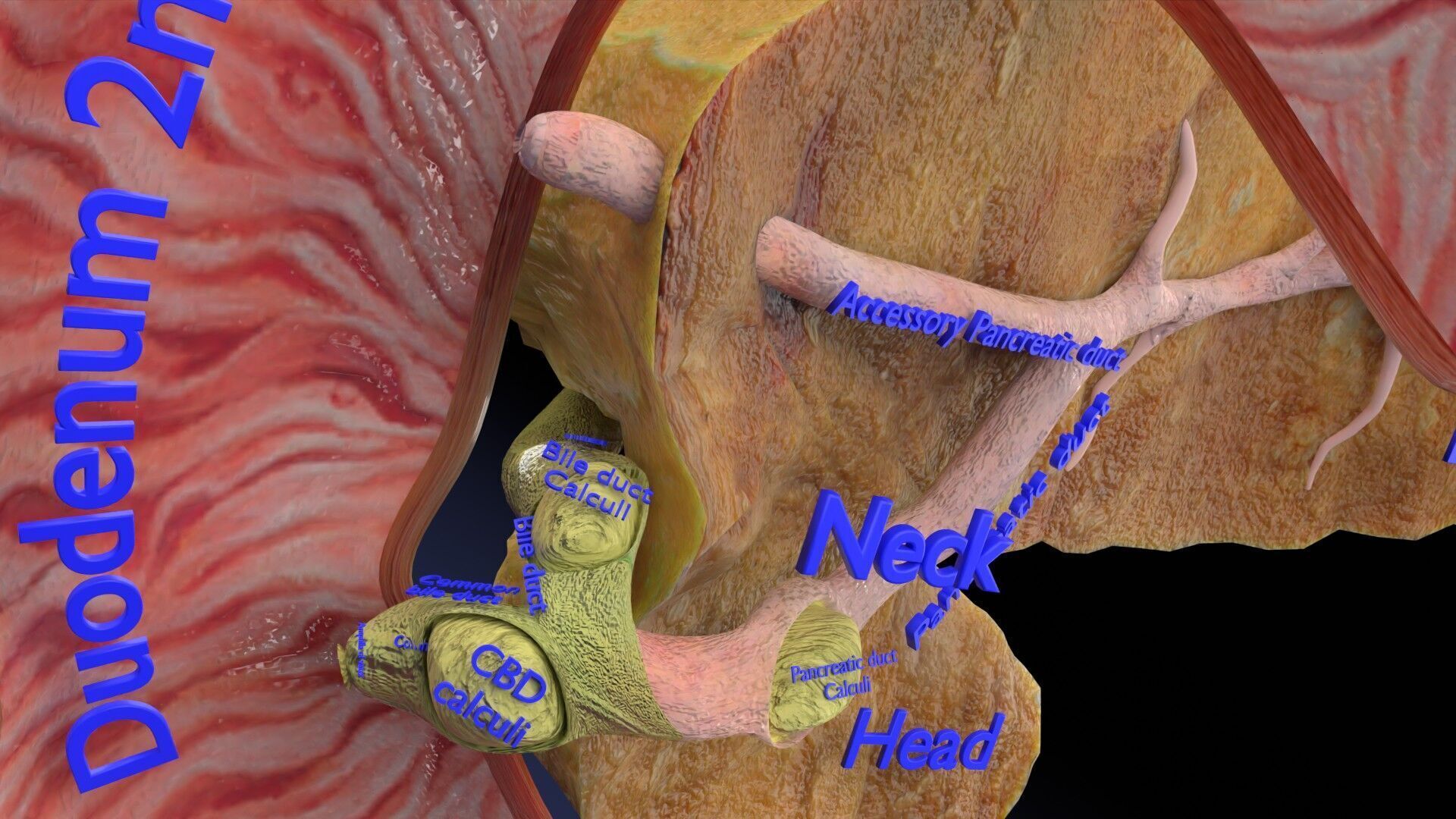 Biliary tract stone obstructions gallstone Low-poly 3D model_23