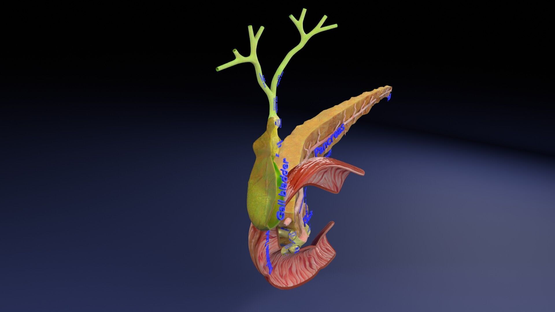 Biliary tract stone obstructions gallstone Low-poly 3D model_39