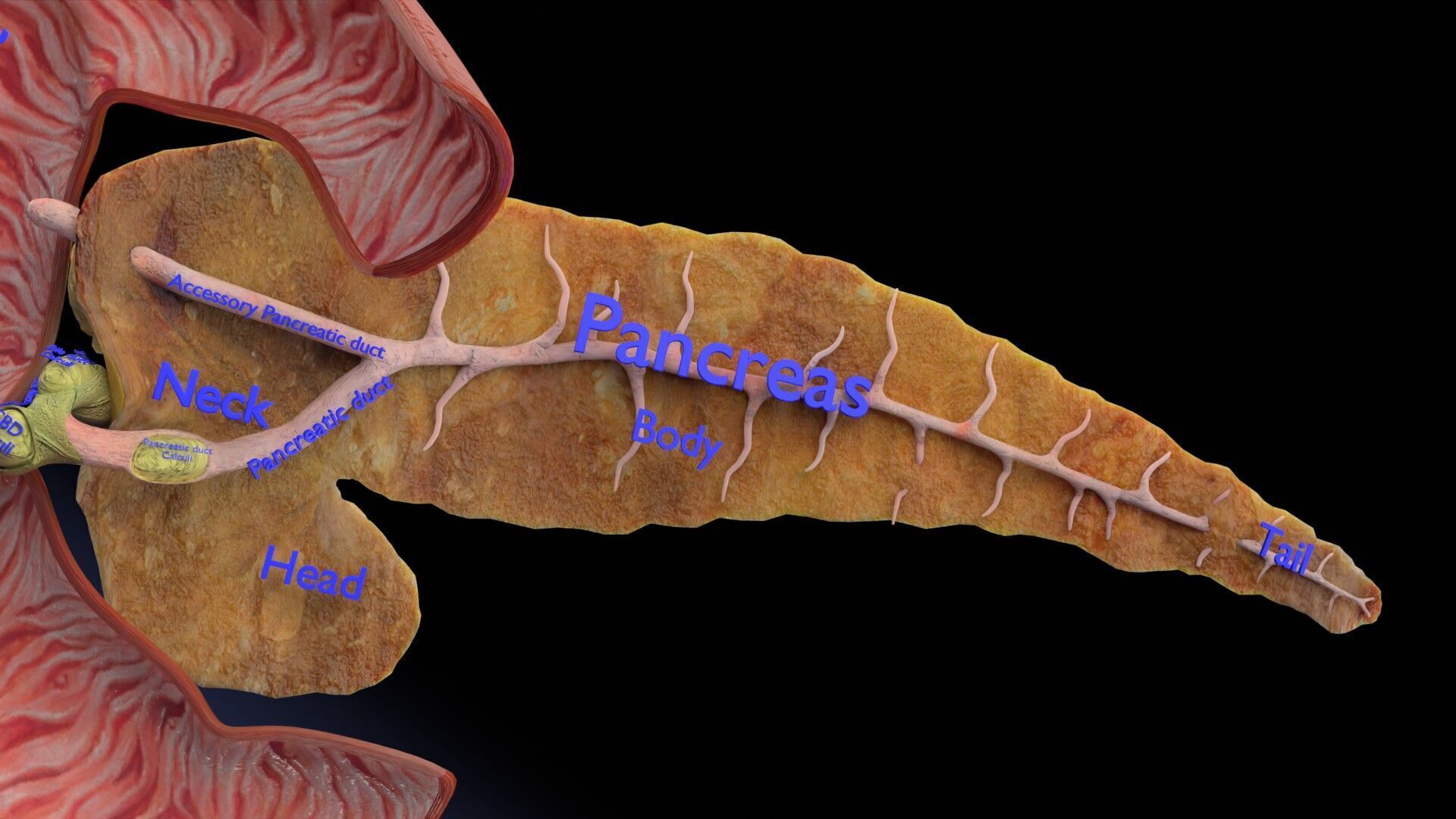 Biliary tract stone obstructions gallstone Low-poly 3D model_21