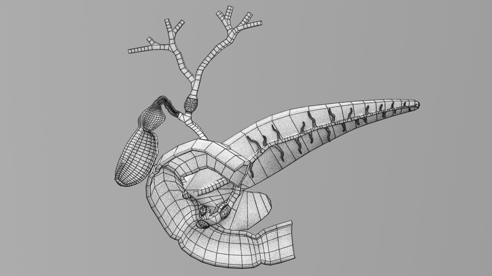 Biliary tract stone obstructions gallstone Low-poly 3D model_80