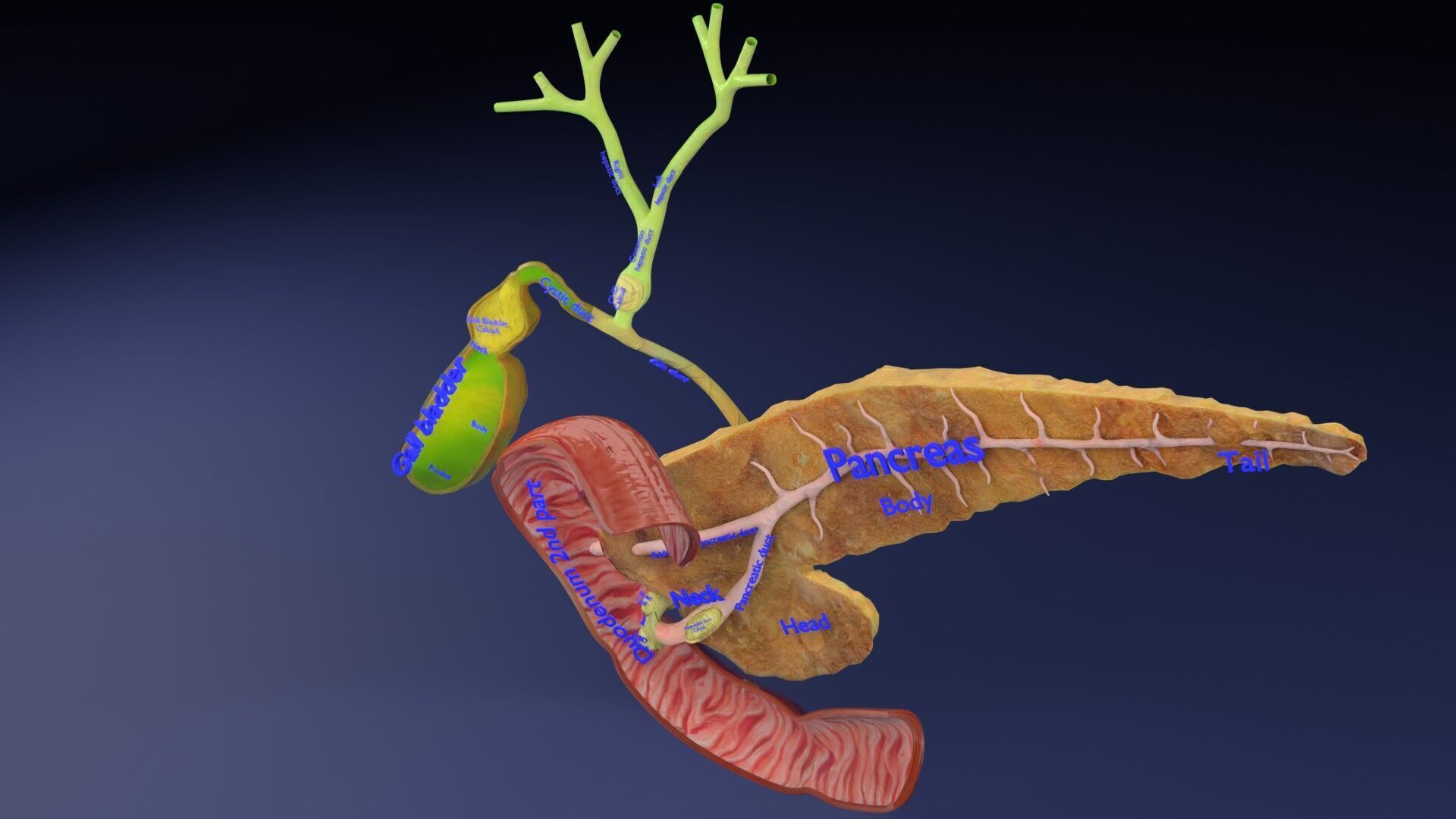 Biliary tract stone obstructions gallstone Low-poly 3D model_3