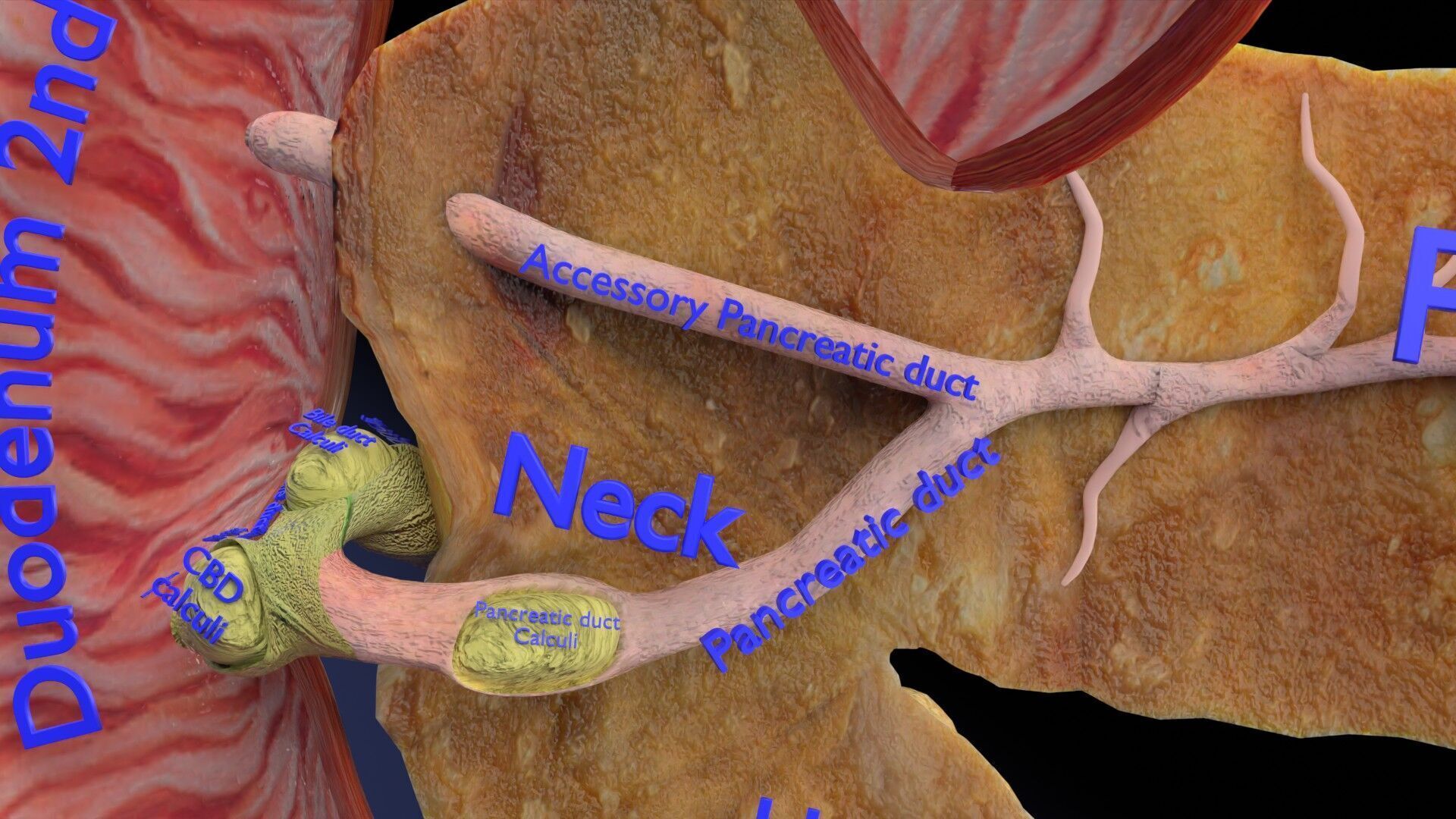 Biliary tract stone obstructions gallstone Low-poly 3D model_22