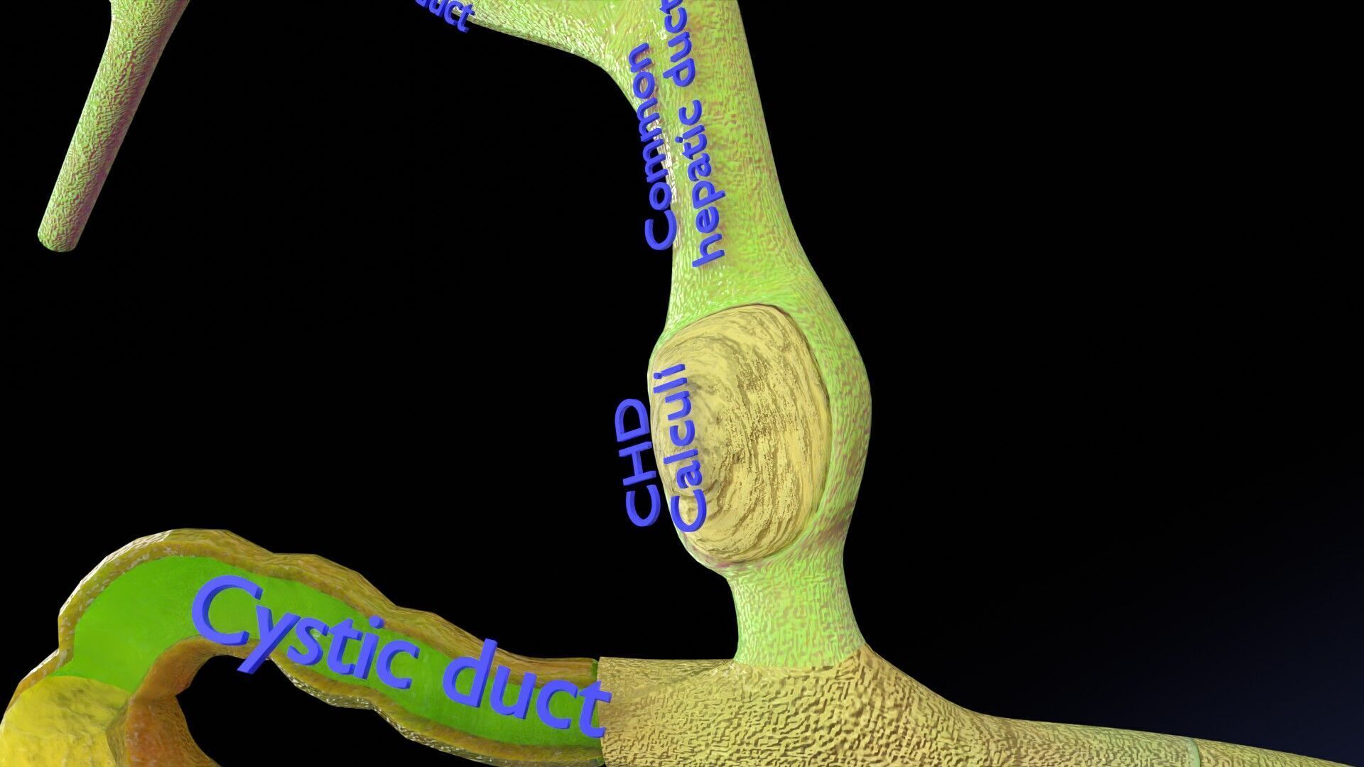 Biliary tract stone obstructions gallstone Low-poly 3D model_13