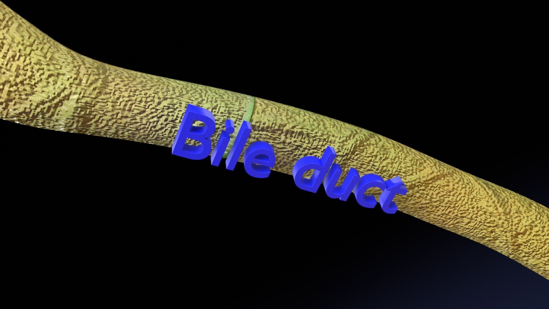 Biliary tract stone obstructions gallstone Low-poly 3D model_14