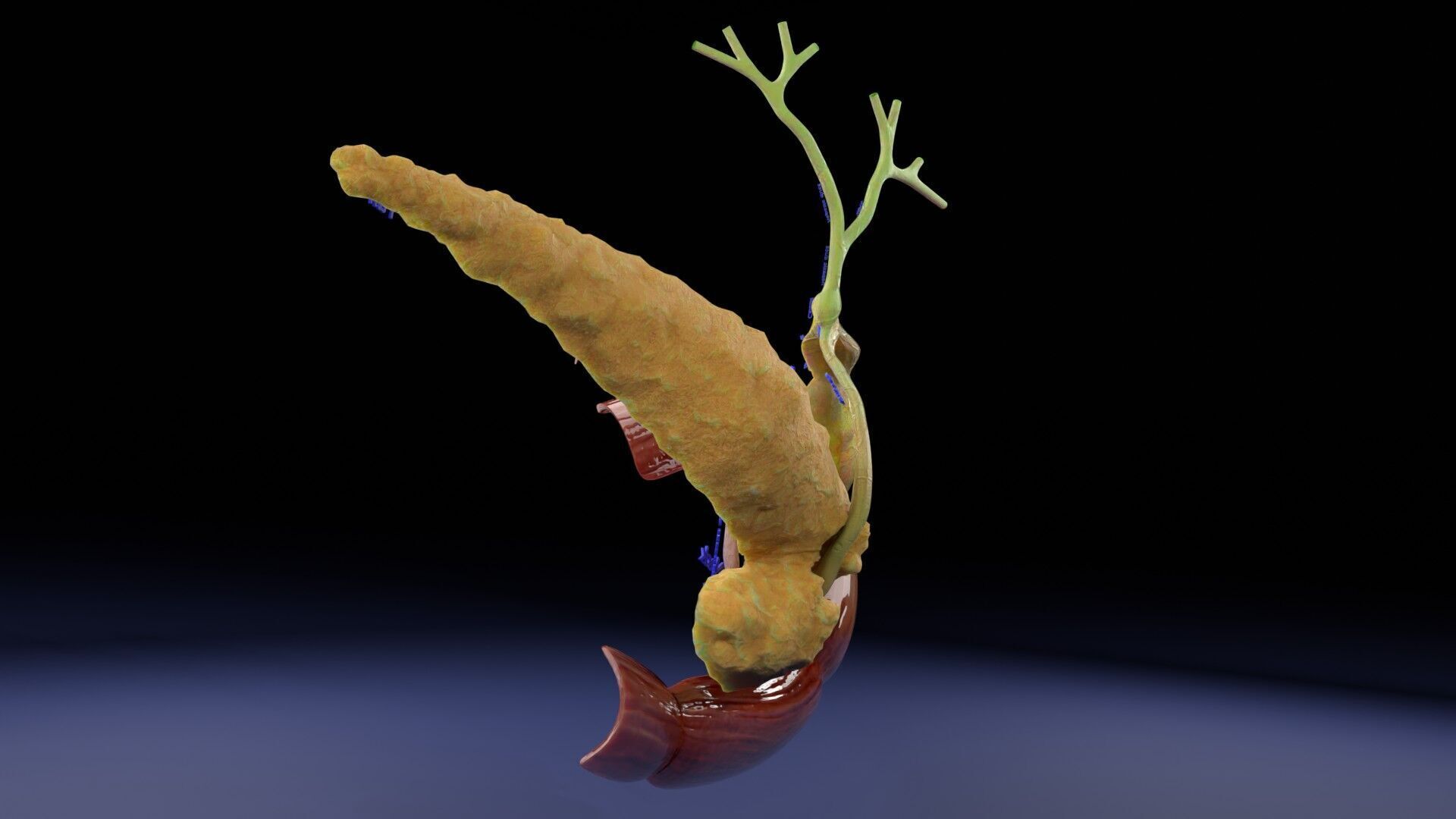 Biliary tract stone obstructions gallstone Low-poly 3D model_35