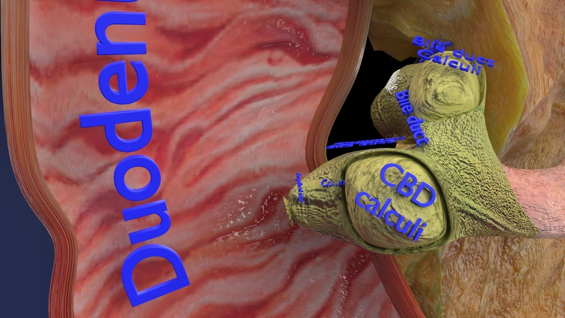 Biliary tract stone obstructions gallstone Low-poly 3D model_30