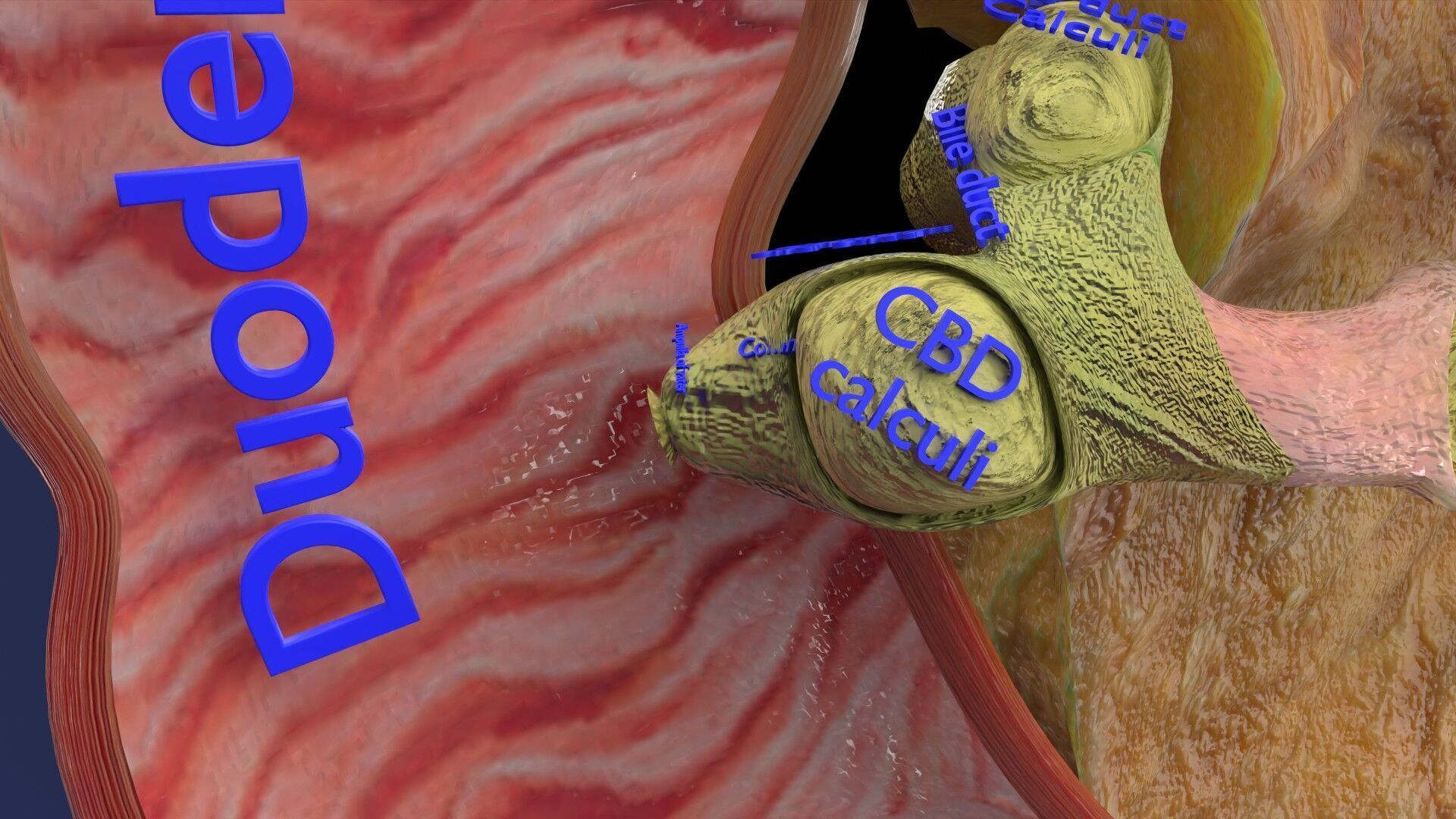 Biliary tract stone obstructions gallstone Low-poly 3D model_31