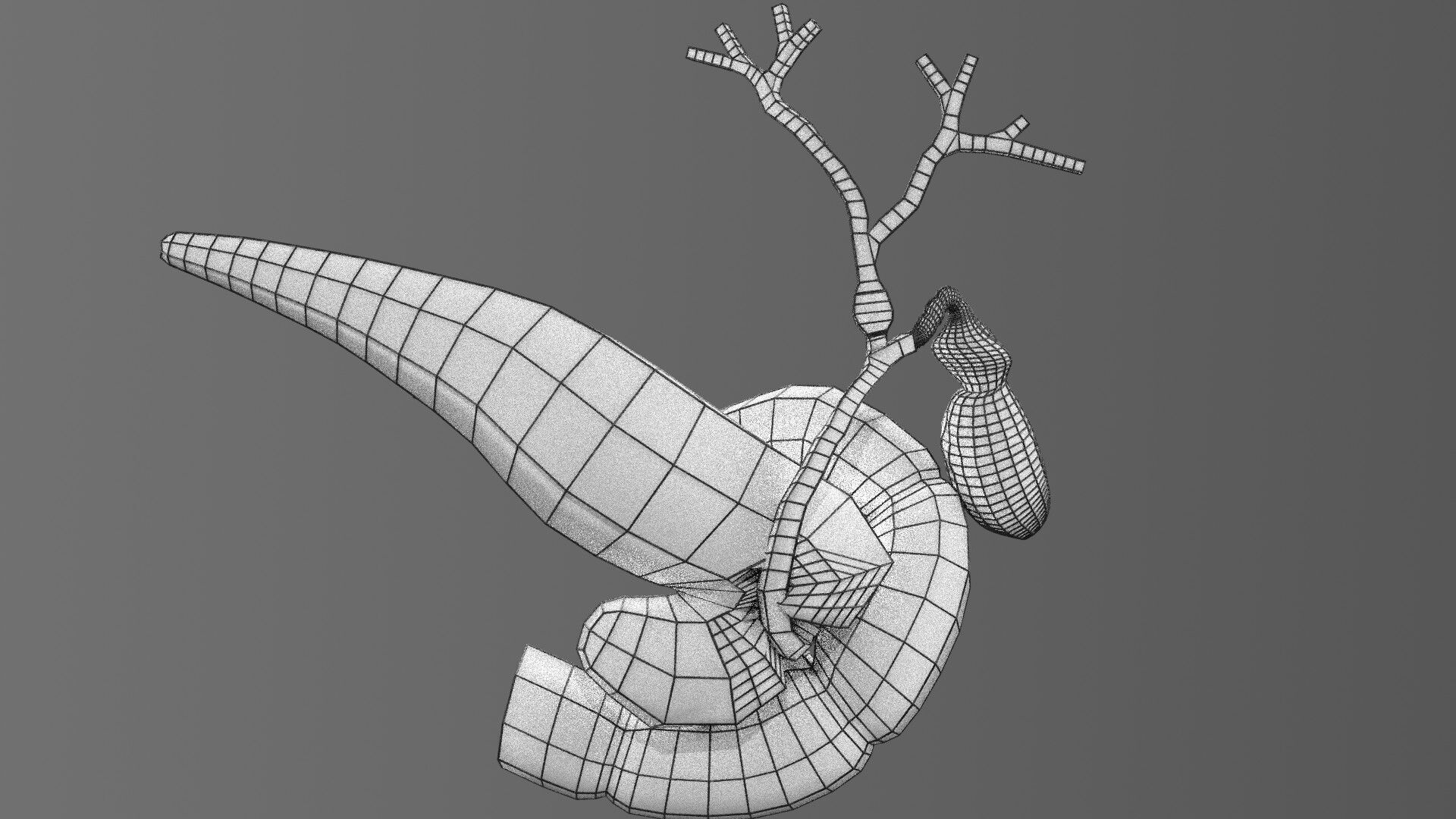 Biliary tract stone obstructions gallstone Low-poly 3D model_76