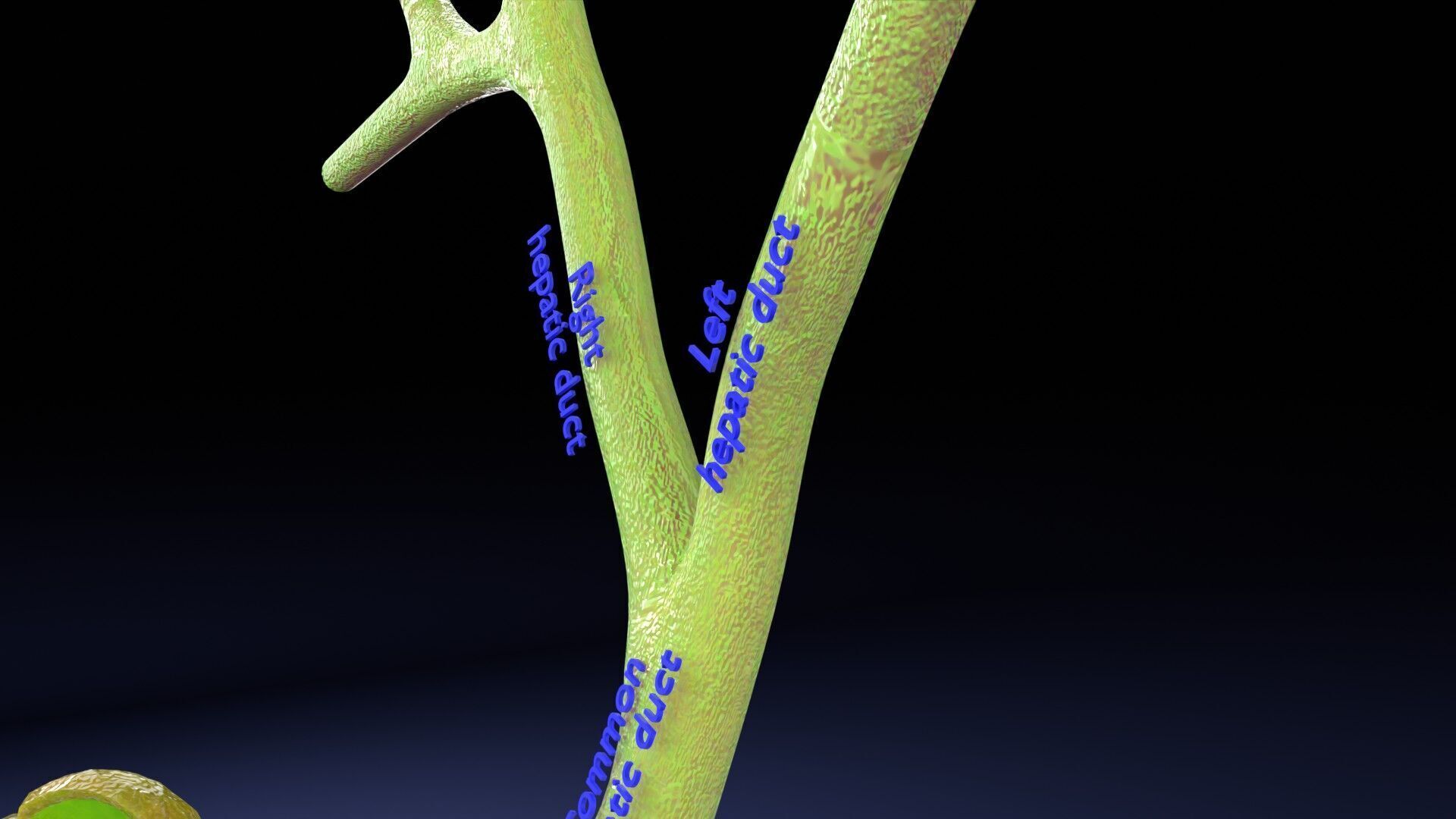 Biliary tract stone obstructions gallstone Low-poly 3D model_5