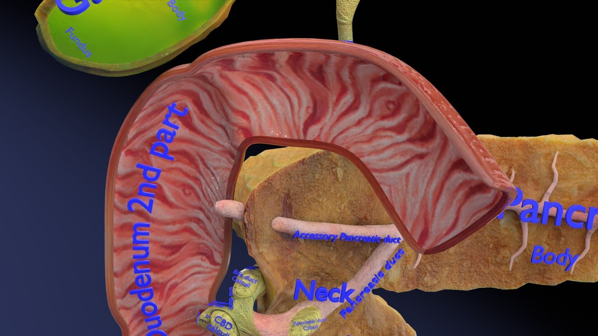 Biliary tract stone obstructions gallstone Low-poly 3D model_29