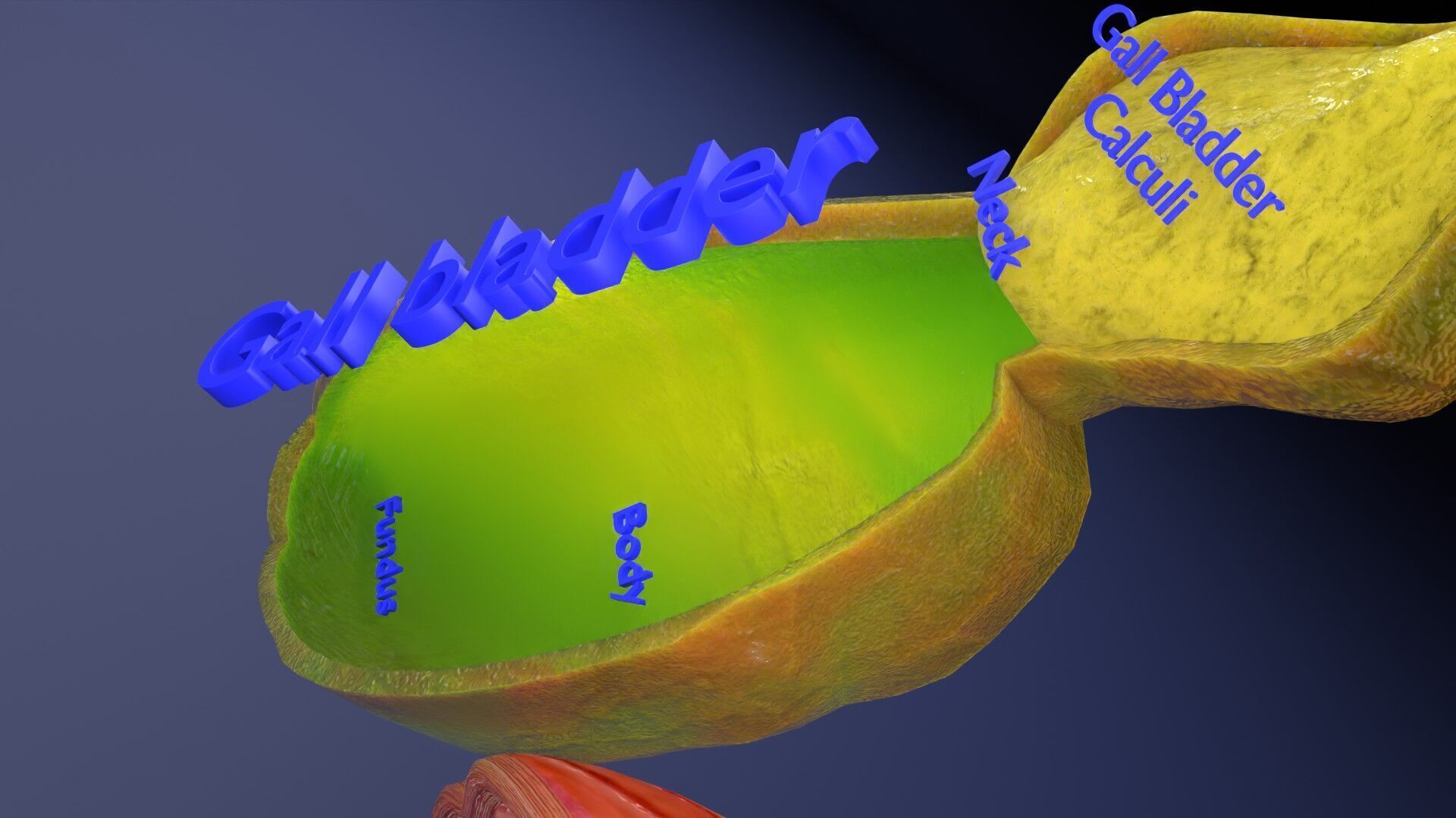 Biliary tract stone obstructions gallstone Low-poly 3D model_7