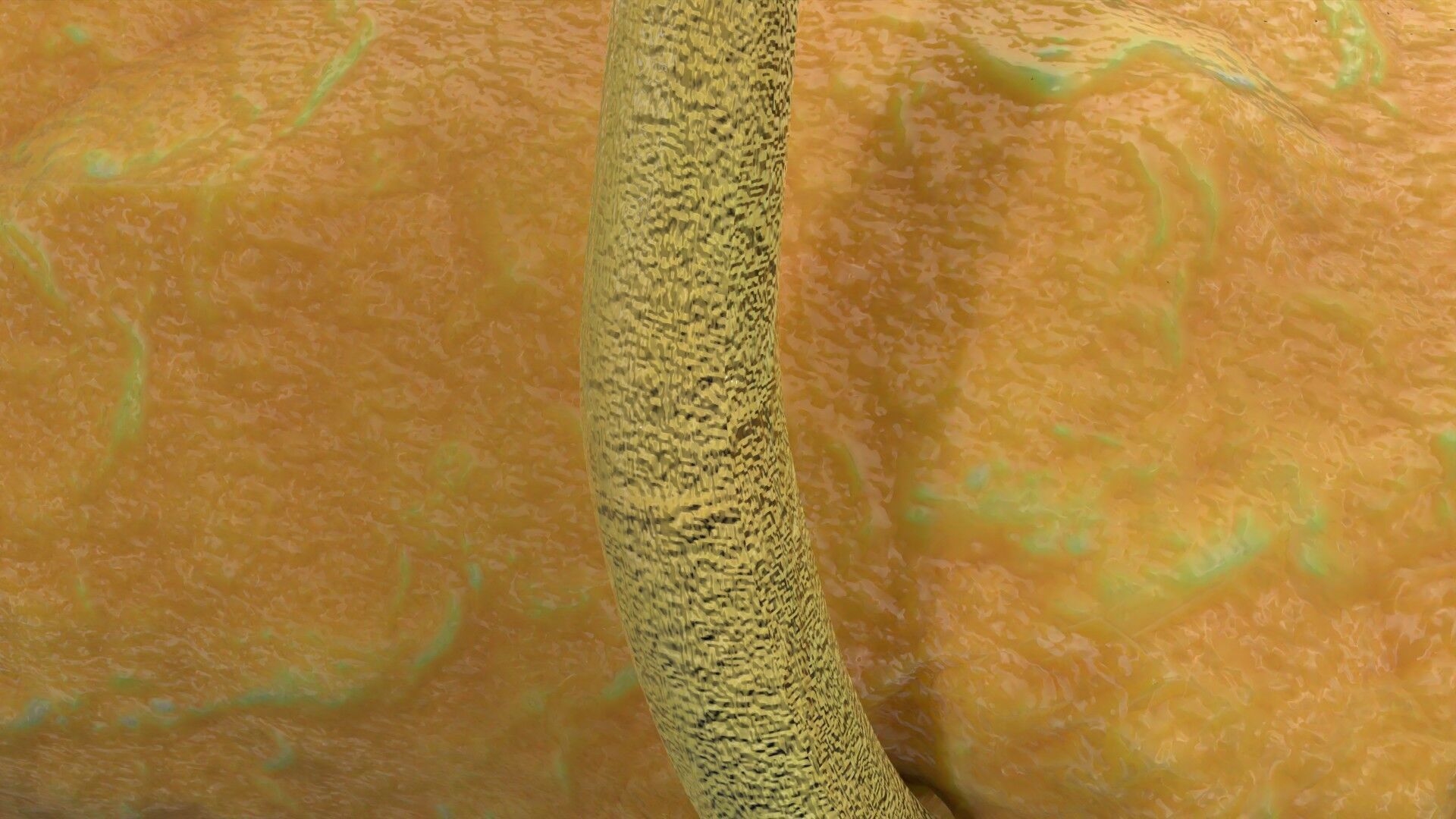 Biliary tract stone obstructions gallstone Low-poly 3D model_16