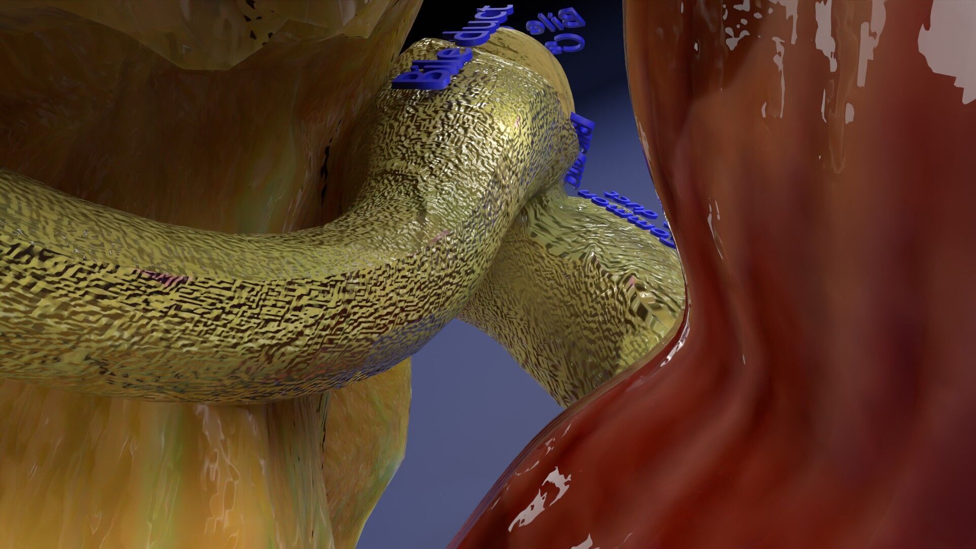 Biliary tract stone obstructions gallstone Low-poly 3D model_17