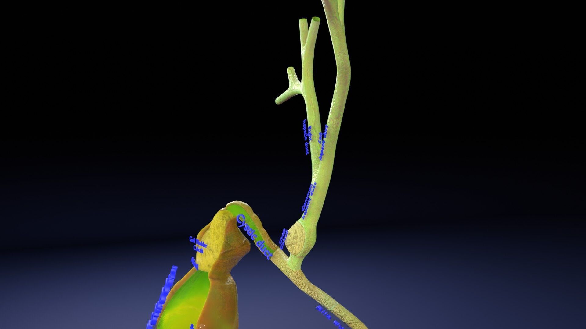 Biliary tract stone obstructions gallstone Low-poly 3D model_4