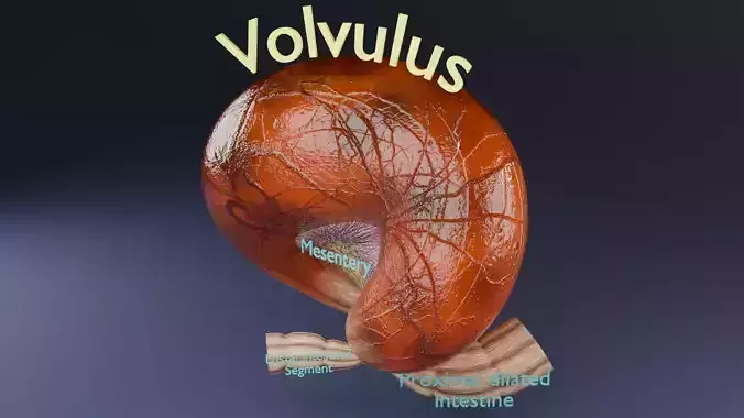 Volvulus intestine obstruction