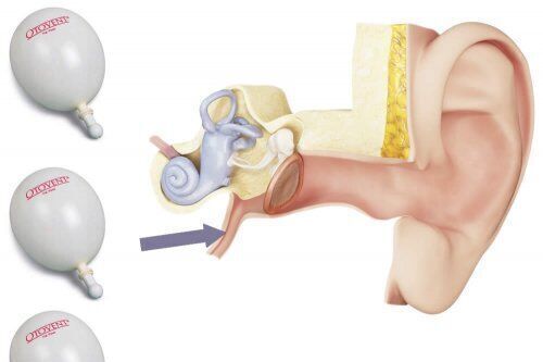 Otovent Adapter Free 3D print model_6