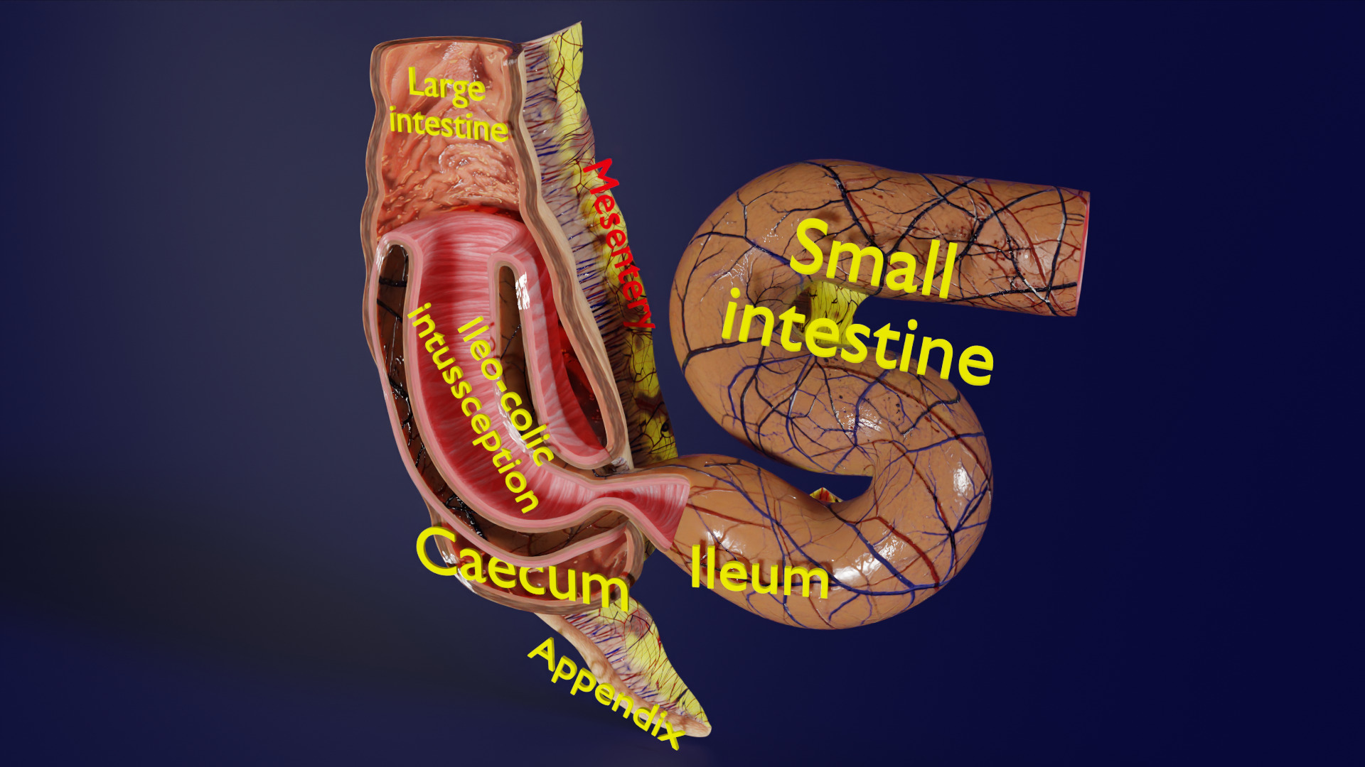 Intussusception intestine ileocolic obstruction Low-poly 3D model_1