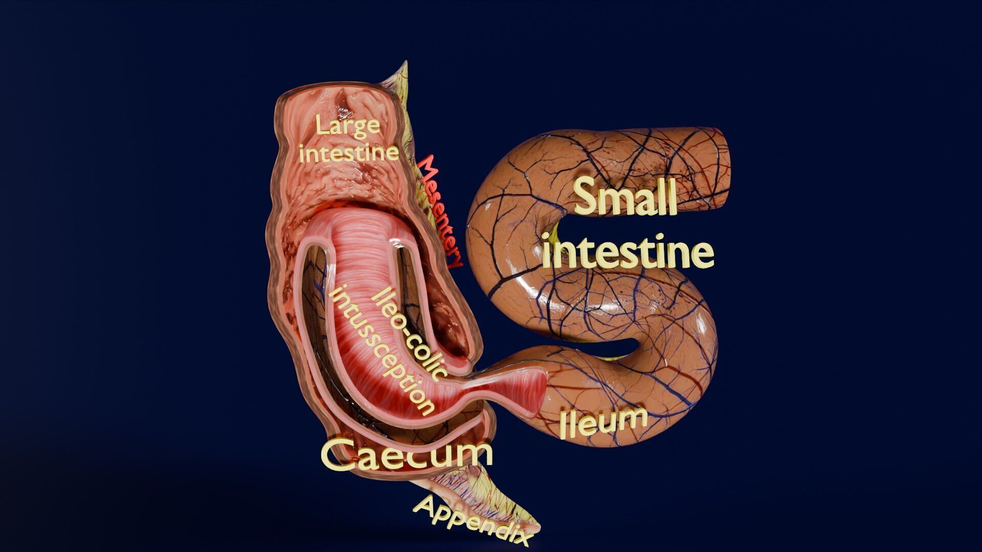 Intussusception intestine ileocolic obstruction Low-poly 3D model_18