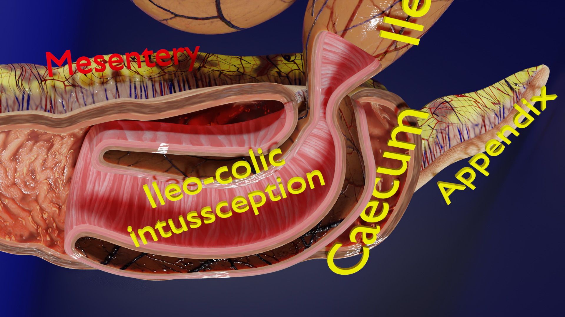 Intussusception intestine ileocolic obstruction Low-poly 3D model_11