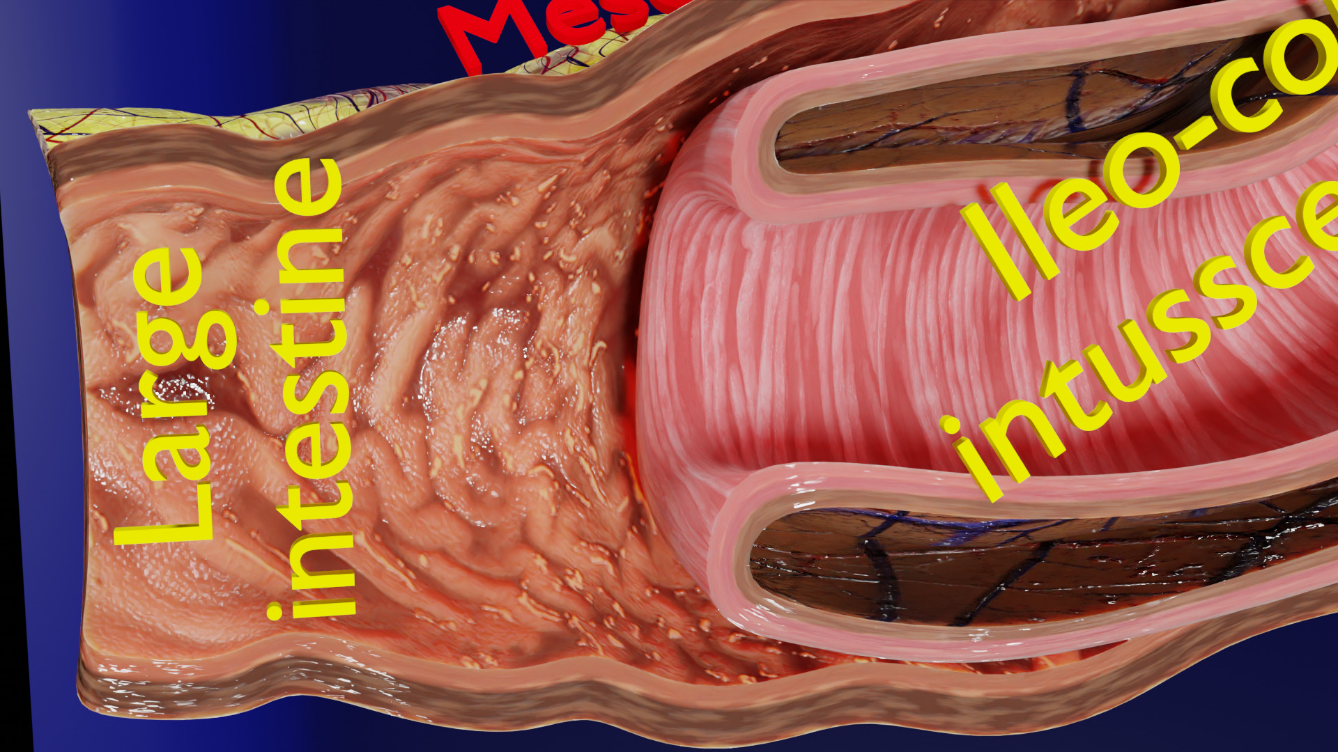 Intussusception intestine ileocolic obstruction Low-poly 3D model_13