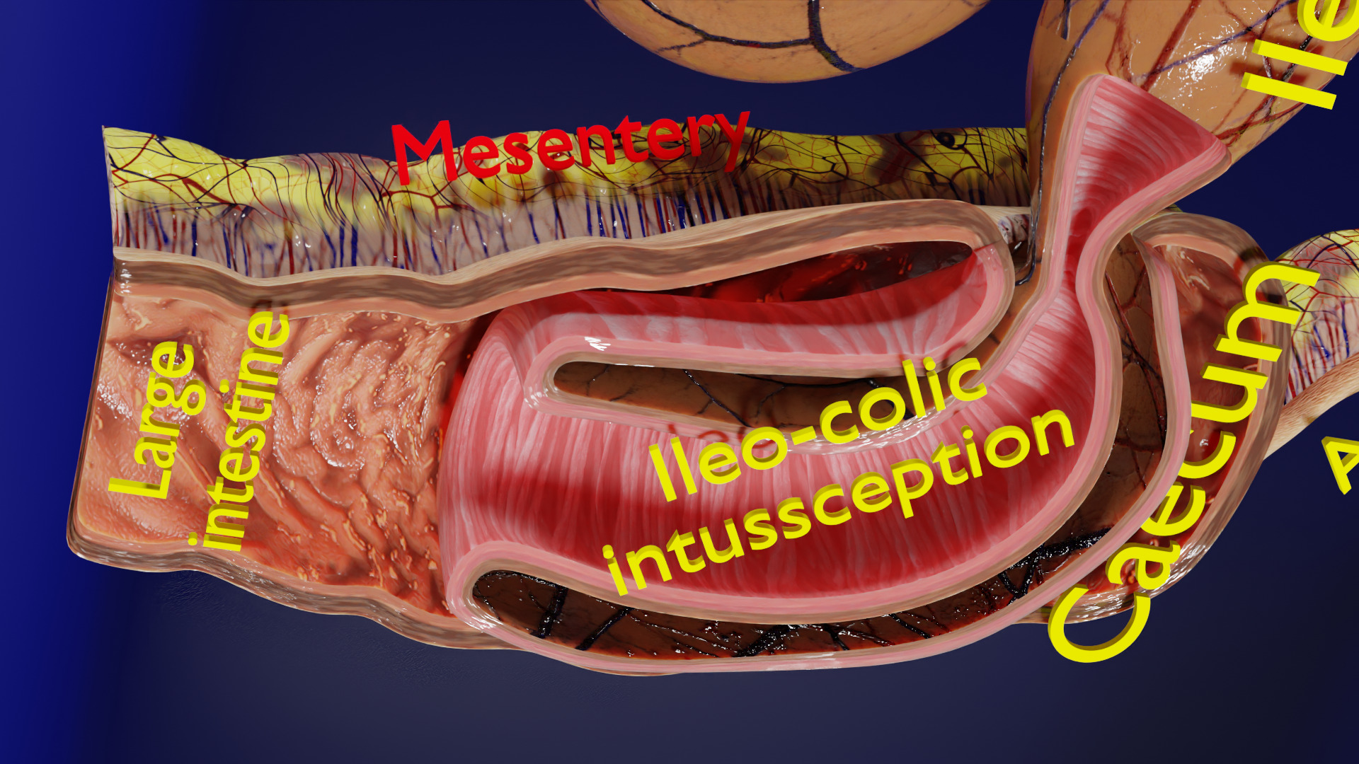 Intussusception intestine ileocolic obstruction Low-poly 3D model_12