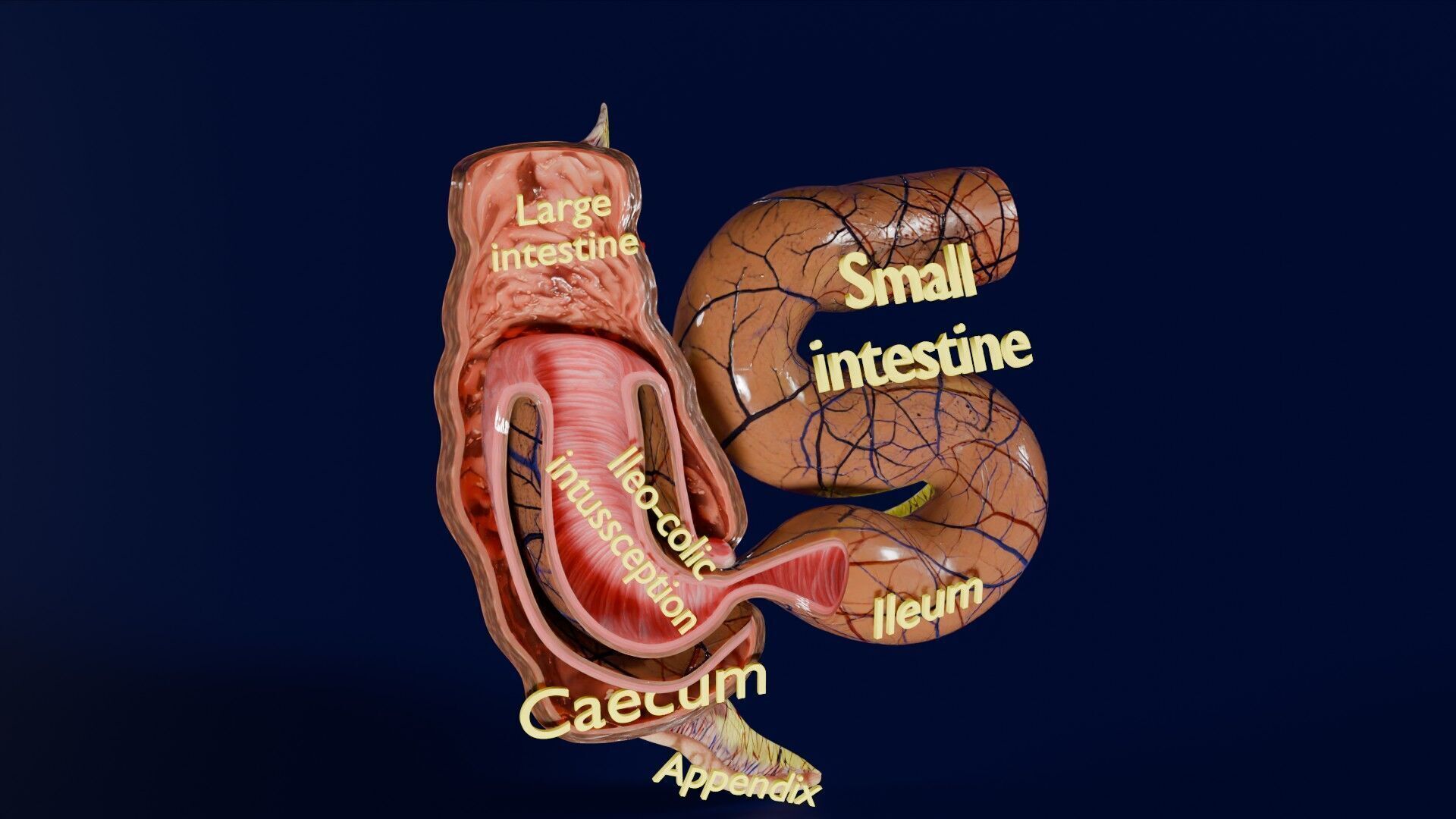 Intussusception intestine ileocolic obstruction Low-poly 3D model_21