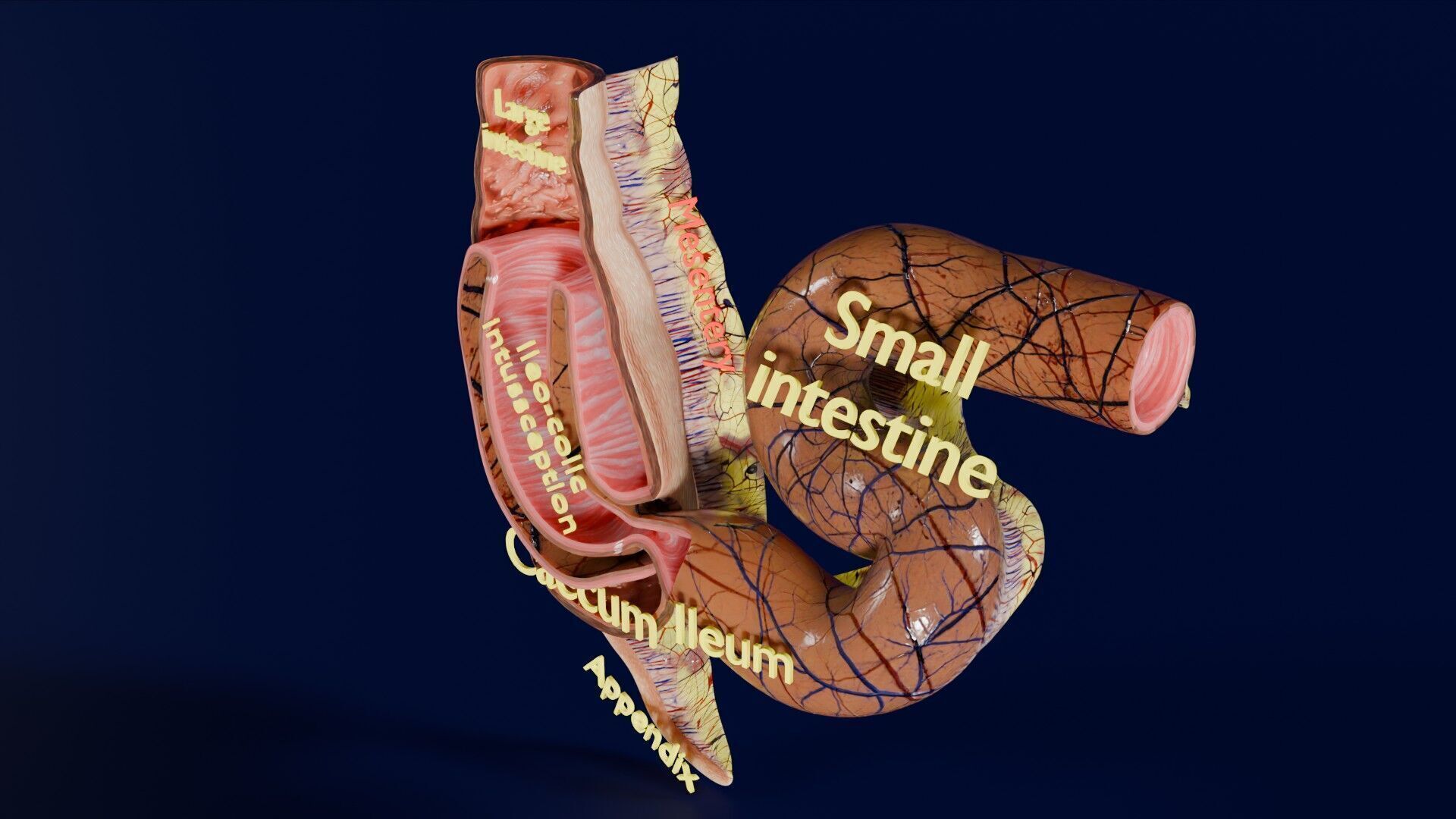 Intussusception intestine ileocolic obstruction Low-poly 3D model_43