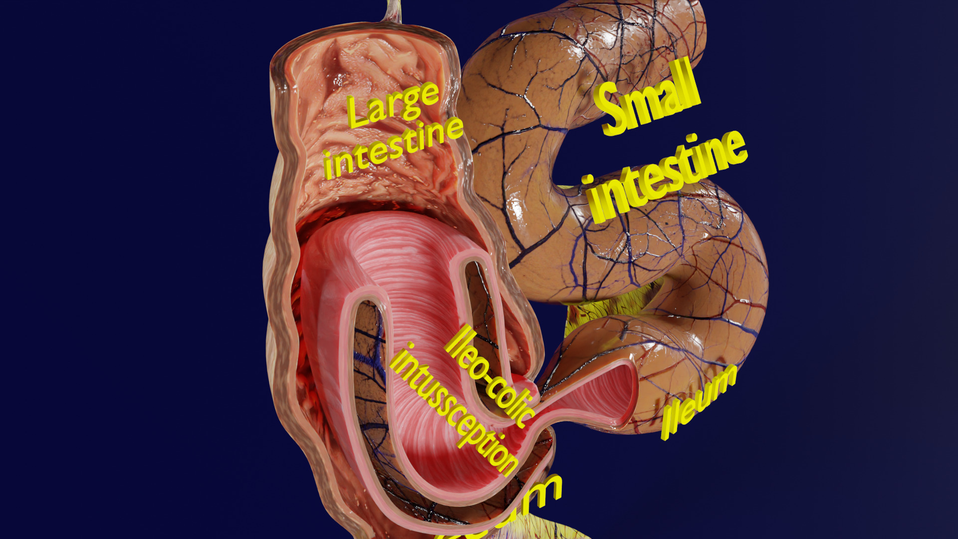 Intussusception intestine ileocolic obstruction Low-poly 3D model_14