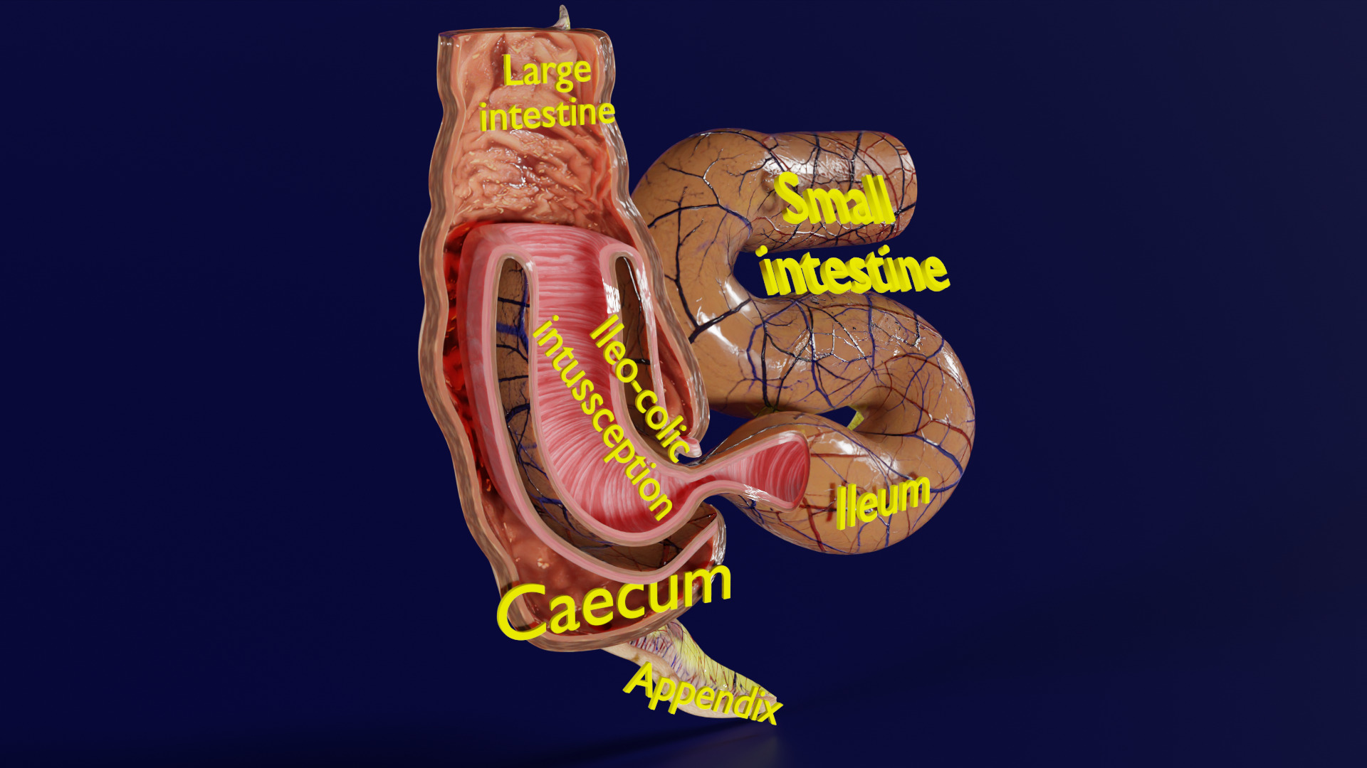 Intussusception intestine ileocolic obstruction Low-poly 3D model_3