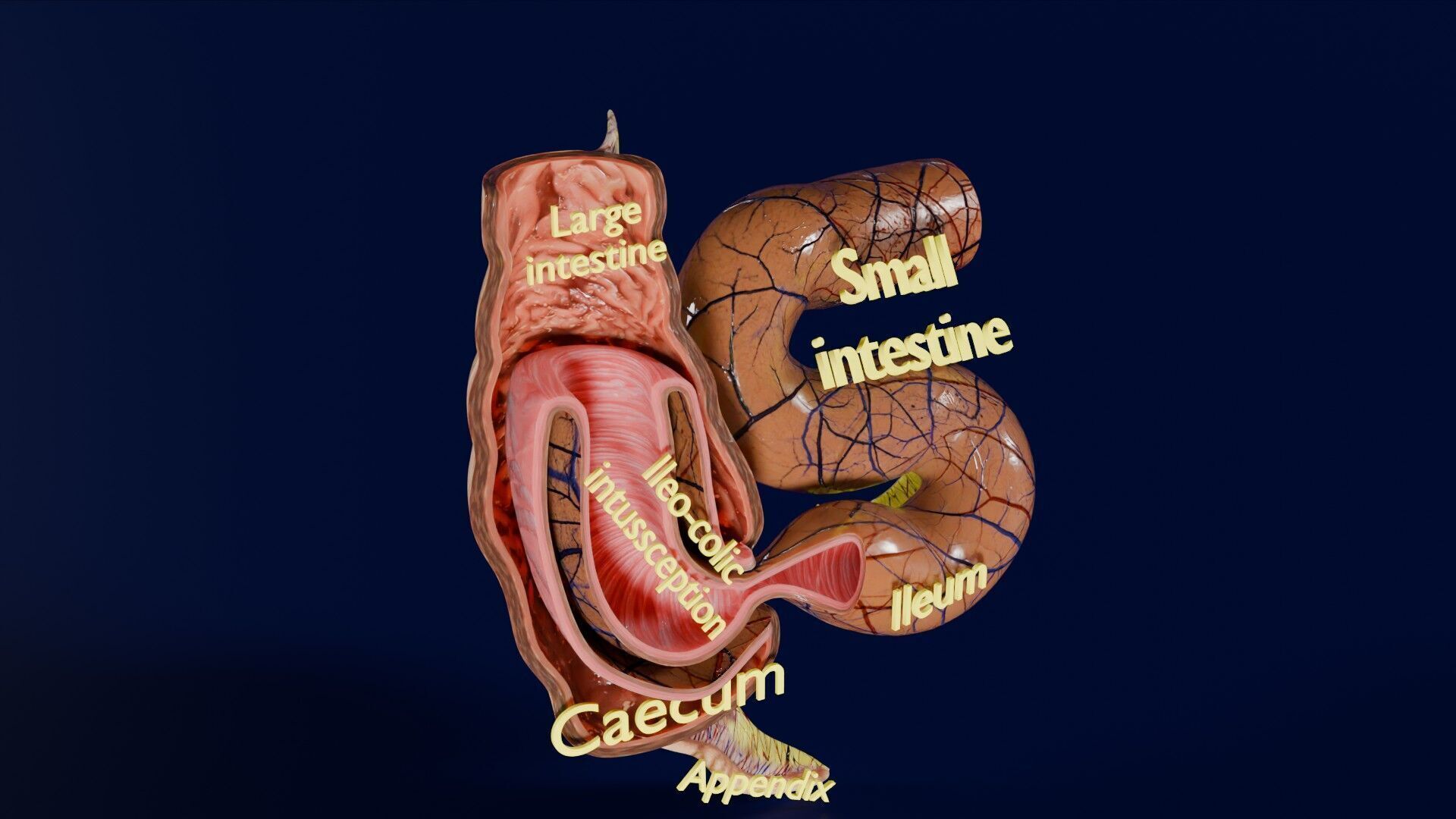 Intussusception intestine ileocolic obstruction Low-poly 3D model_22