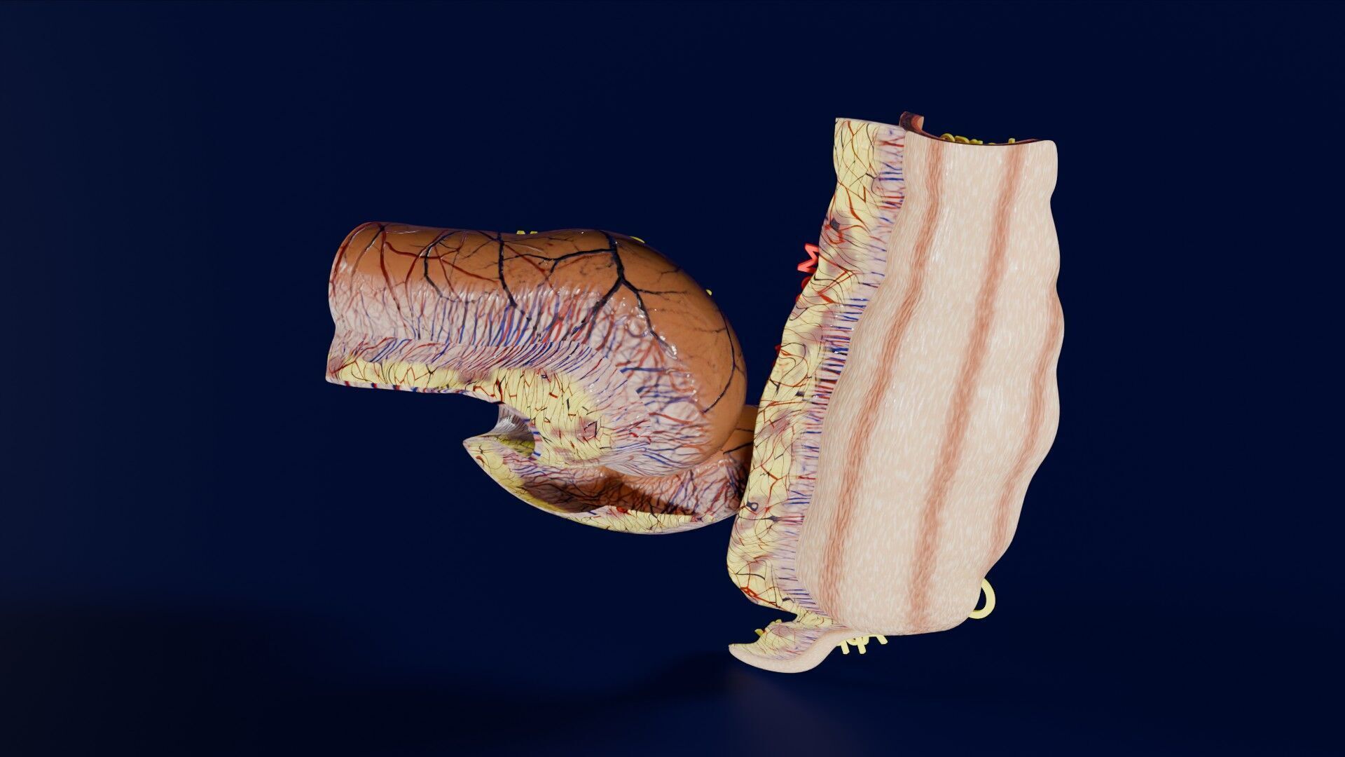 Intussusception intestine ileocolic obstruction Low-poly 3D model_31