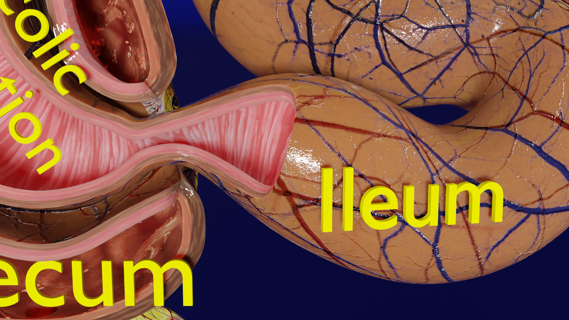 Intussusception intestine ileocolic obstruction Low-poly 3D model_9