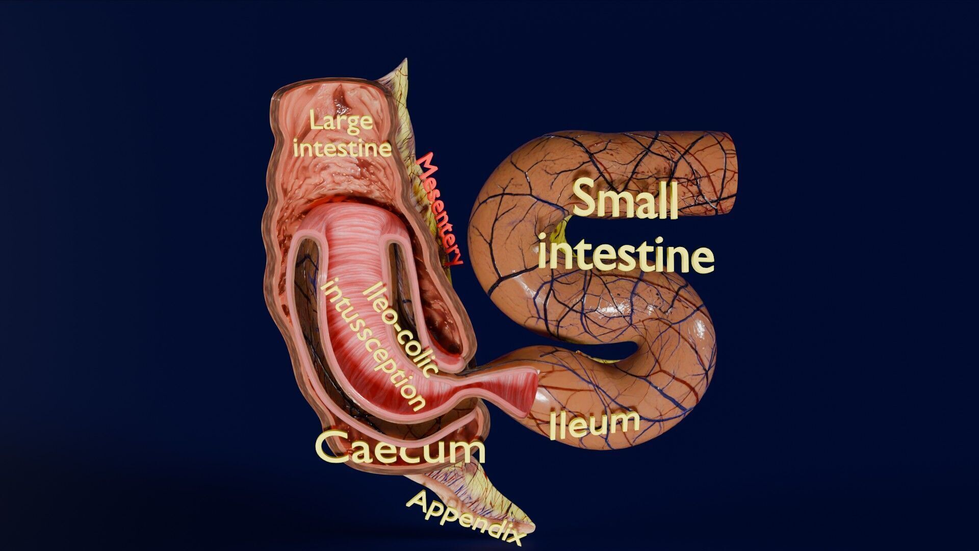Intussusception intestine ileocolic obstruction Low-poly 3D model_50